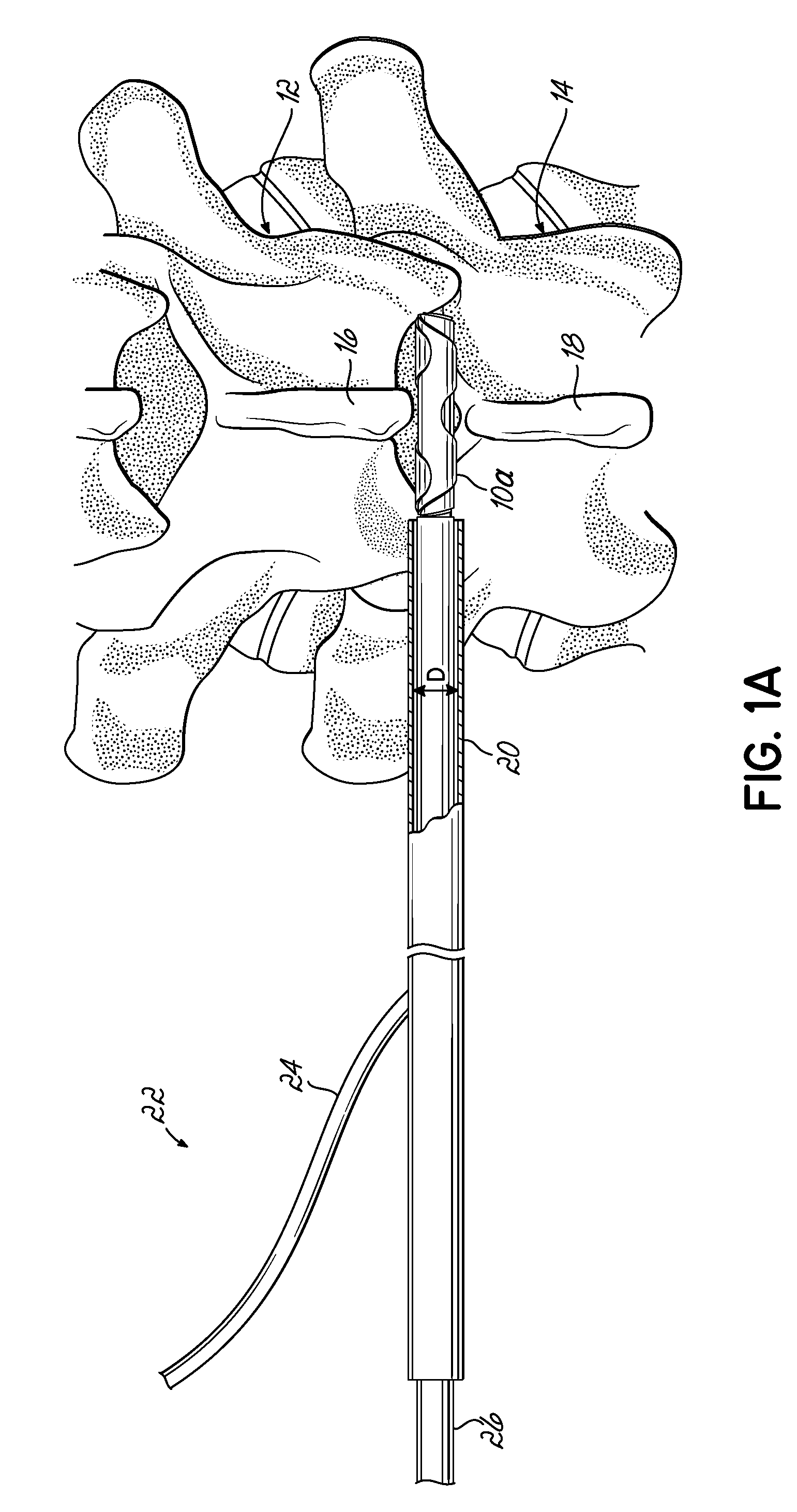 In-situ curable interspinous process spacer