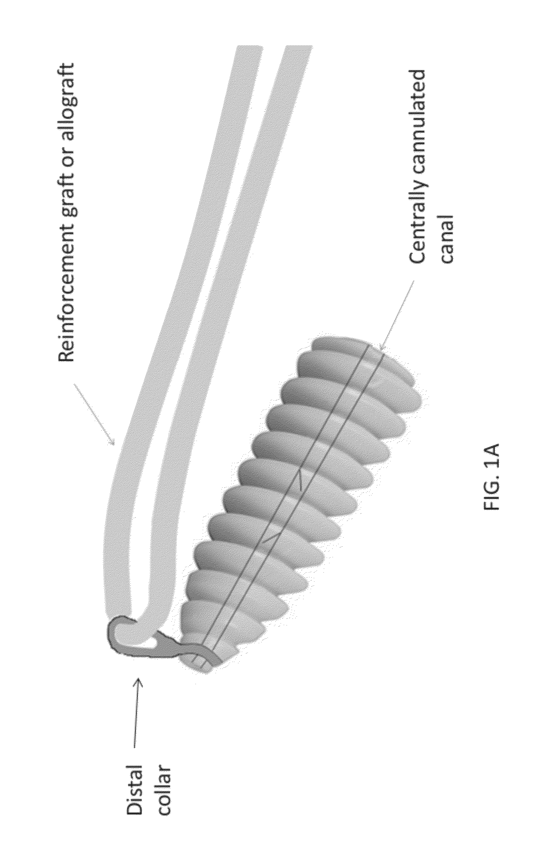Implant and method for repair of the anterior cruciate ligament
