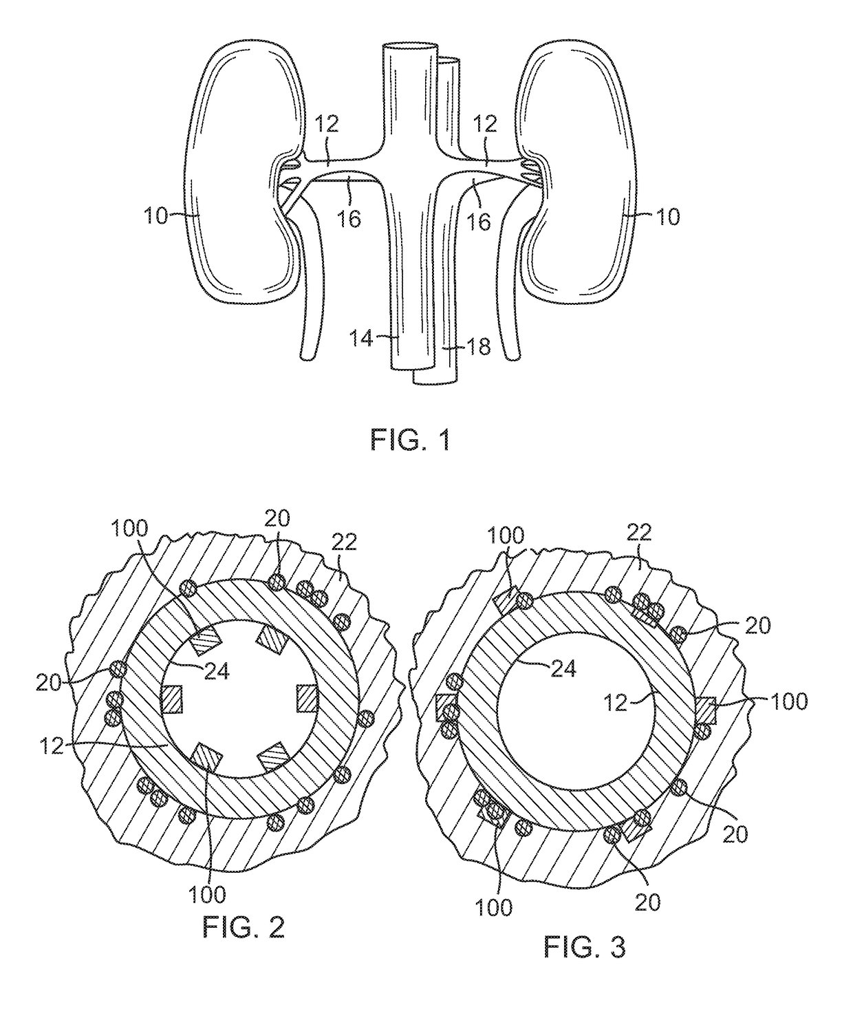 System and method for renal neuromodulation by adjustable oversized stent