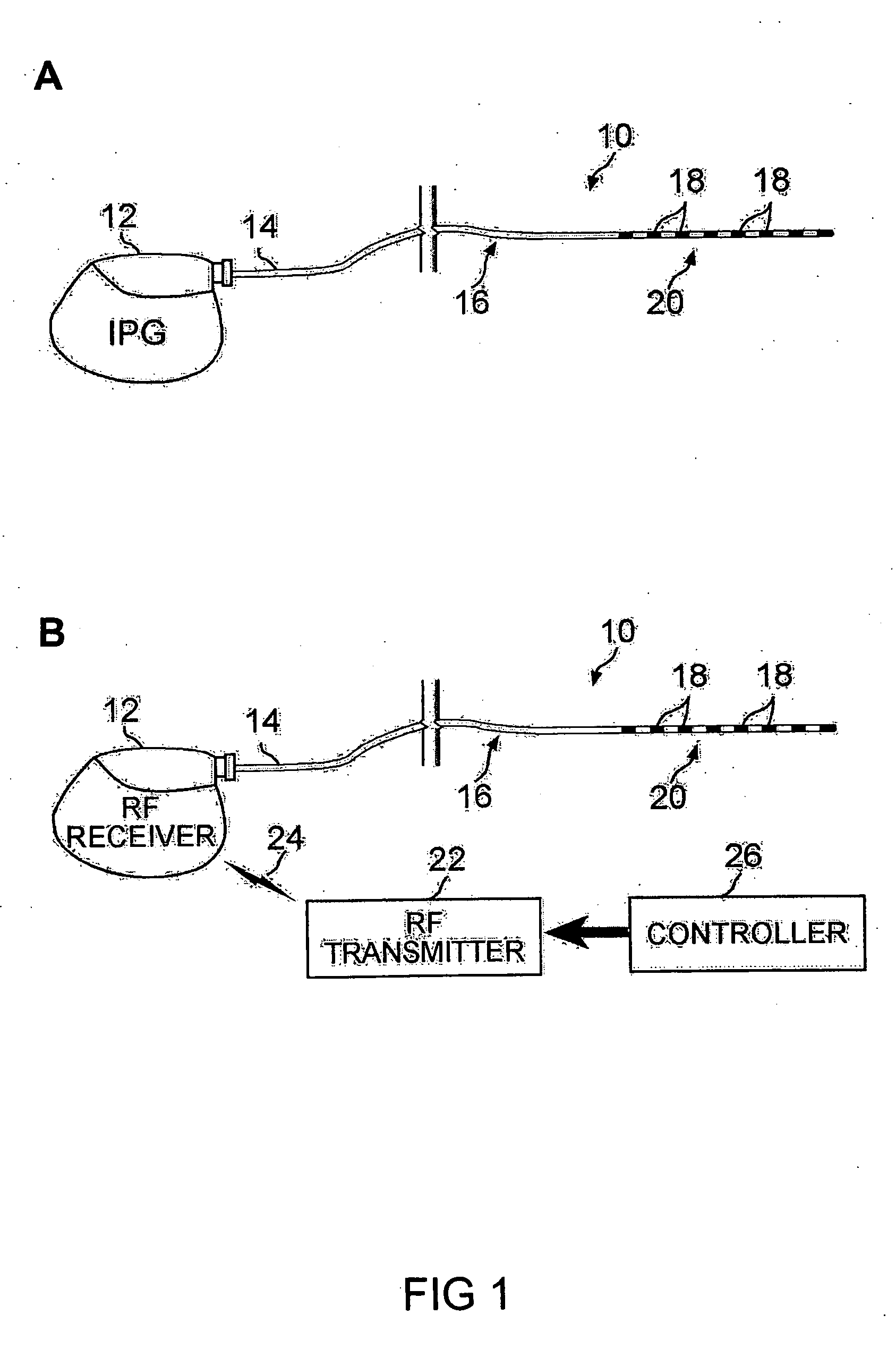 Method of treating depression, mood disorders and anxiety disorders using neuromodulation