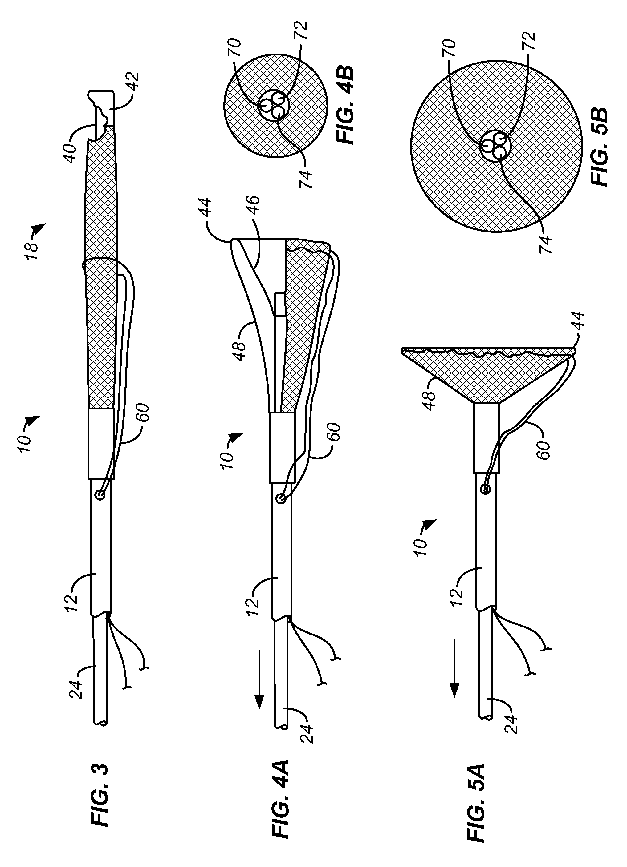 Methods and systems for capturing and removing urinary stones from body cavities