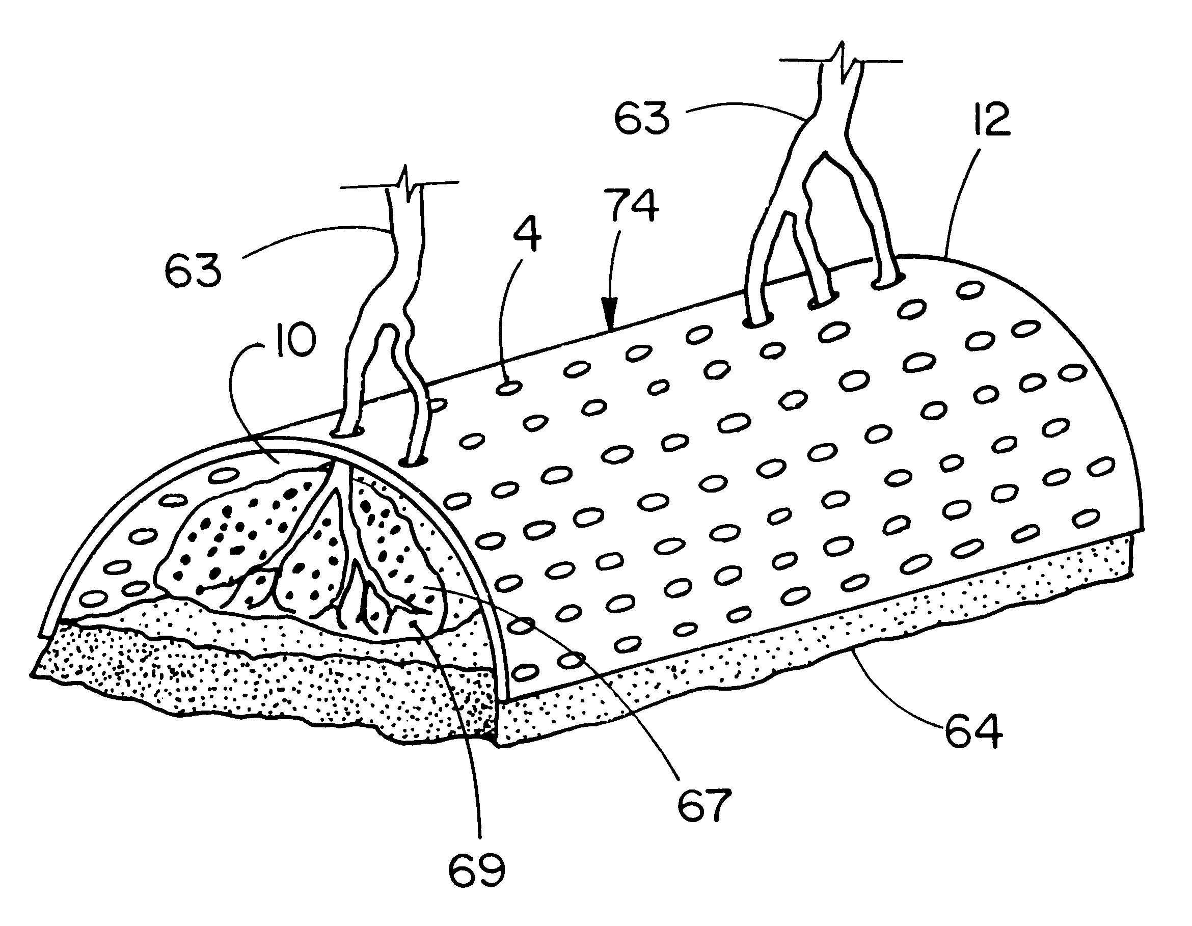 Methods and articles for regenerating bone or peridontal tissue