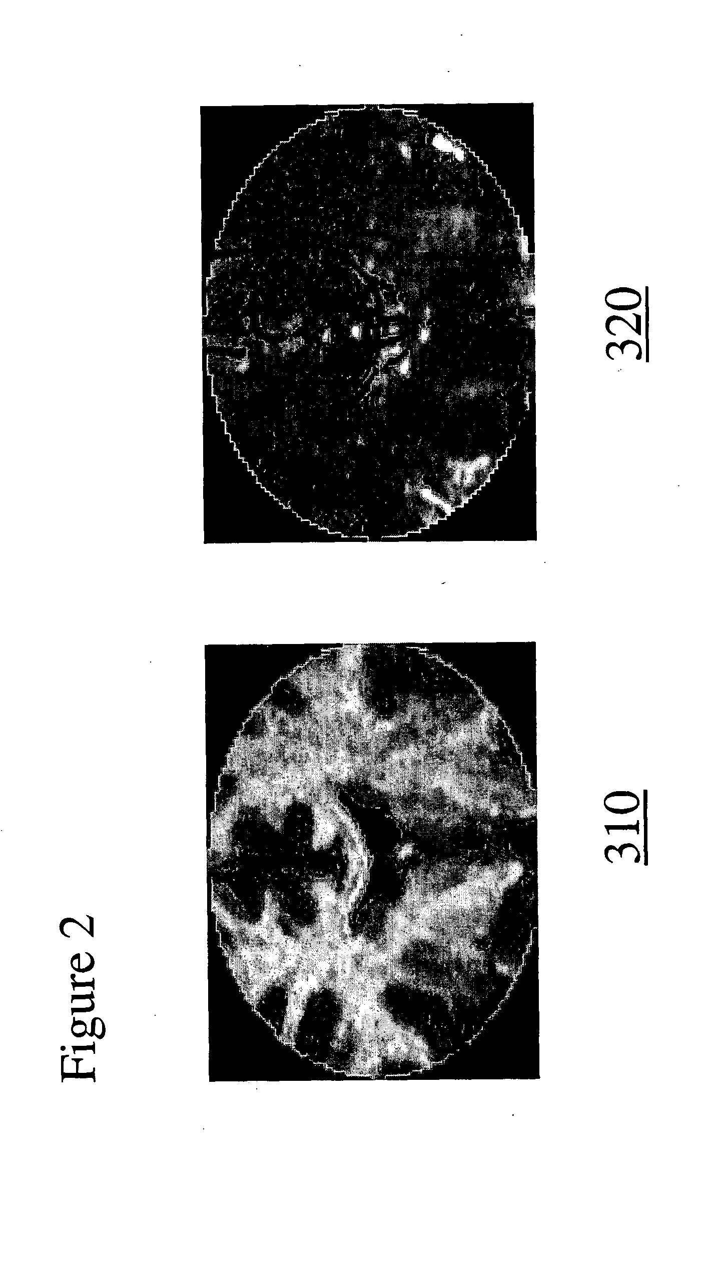 System and method for the detection of brain iron using magnetic resonance imaging