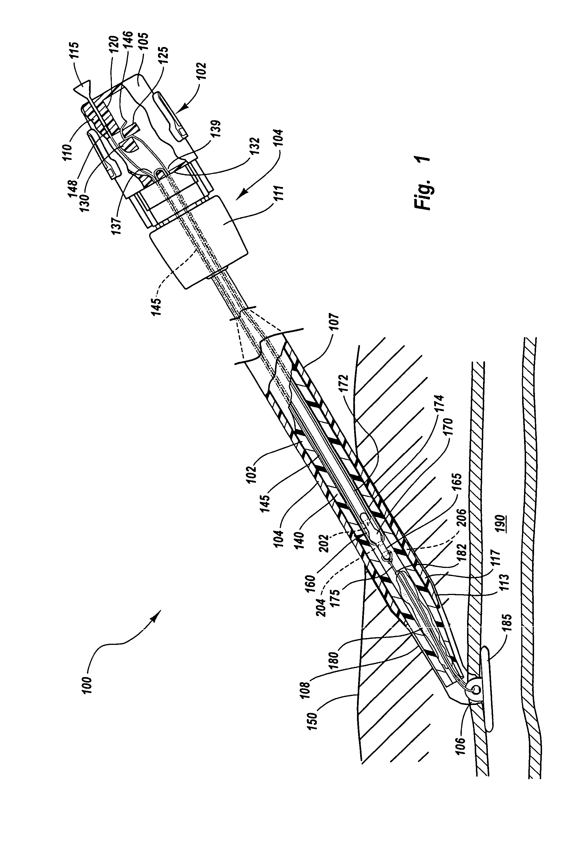 Method and apparatus for sealing an internal tissue puncture incorporating a block and tackle