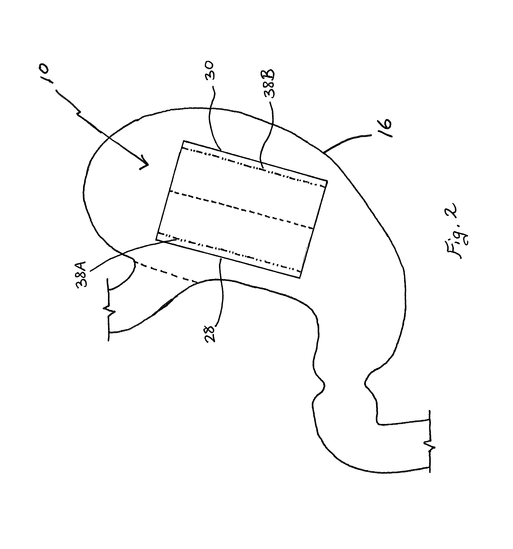 Tissue apposition method and device involving sheets with integrated tensioning system