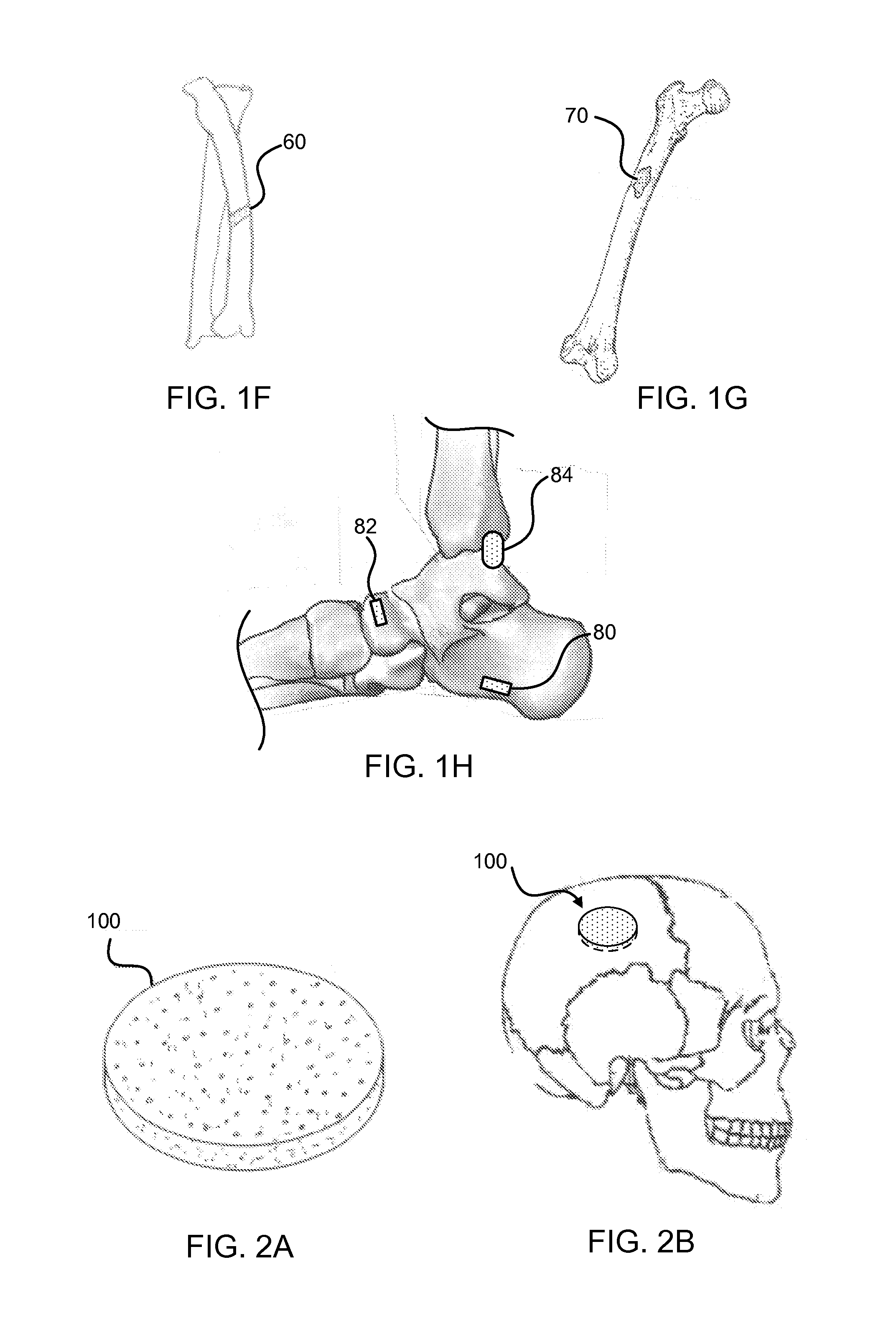 Bone graft materials and methods