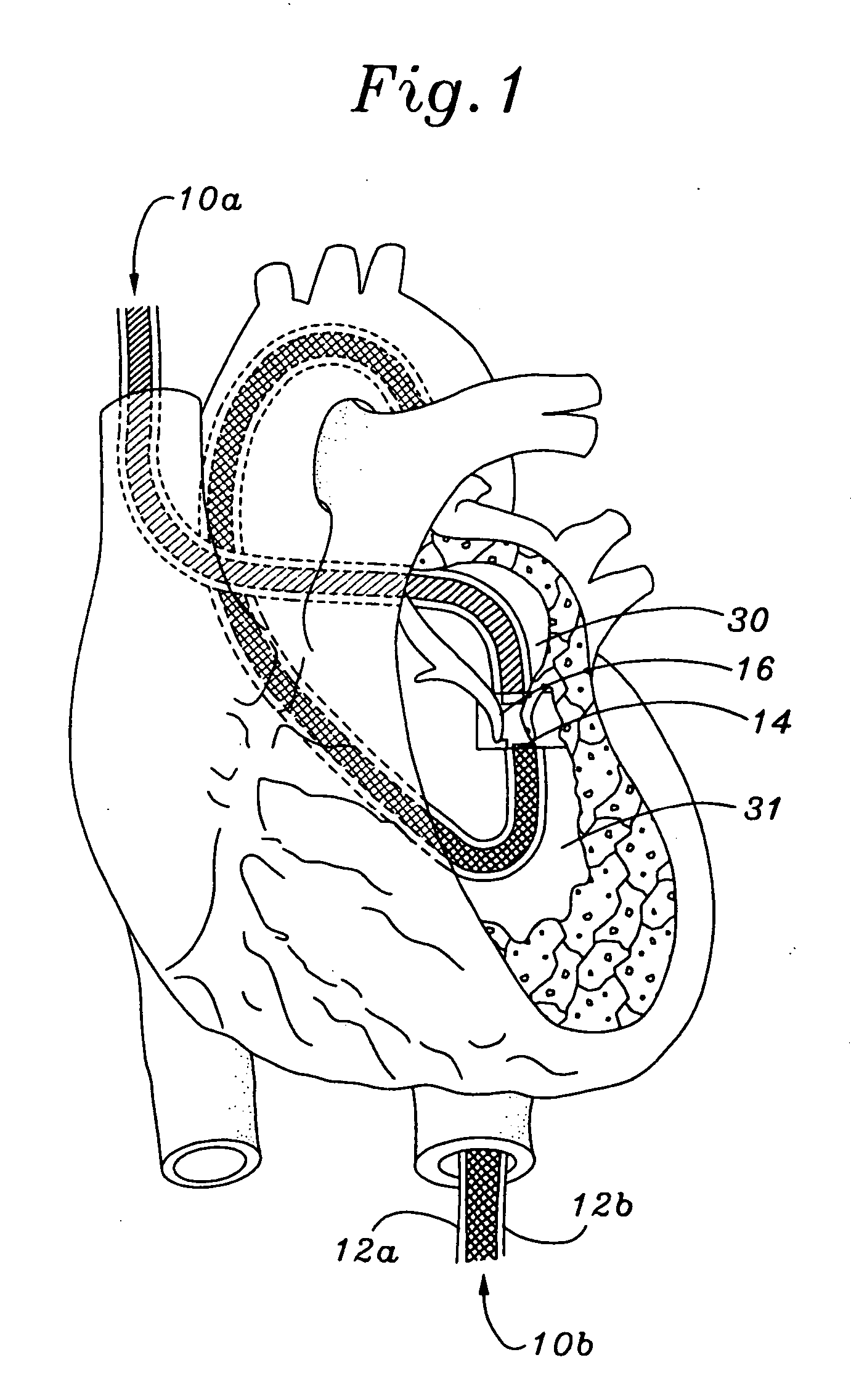 Method and system for tissue repair using dual catheters