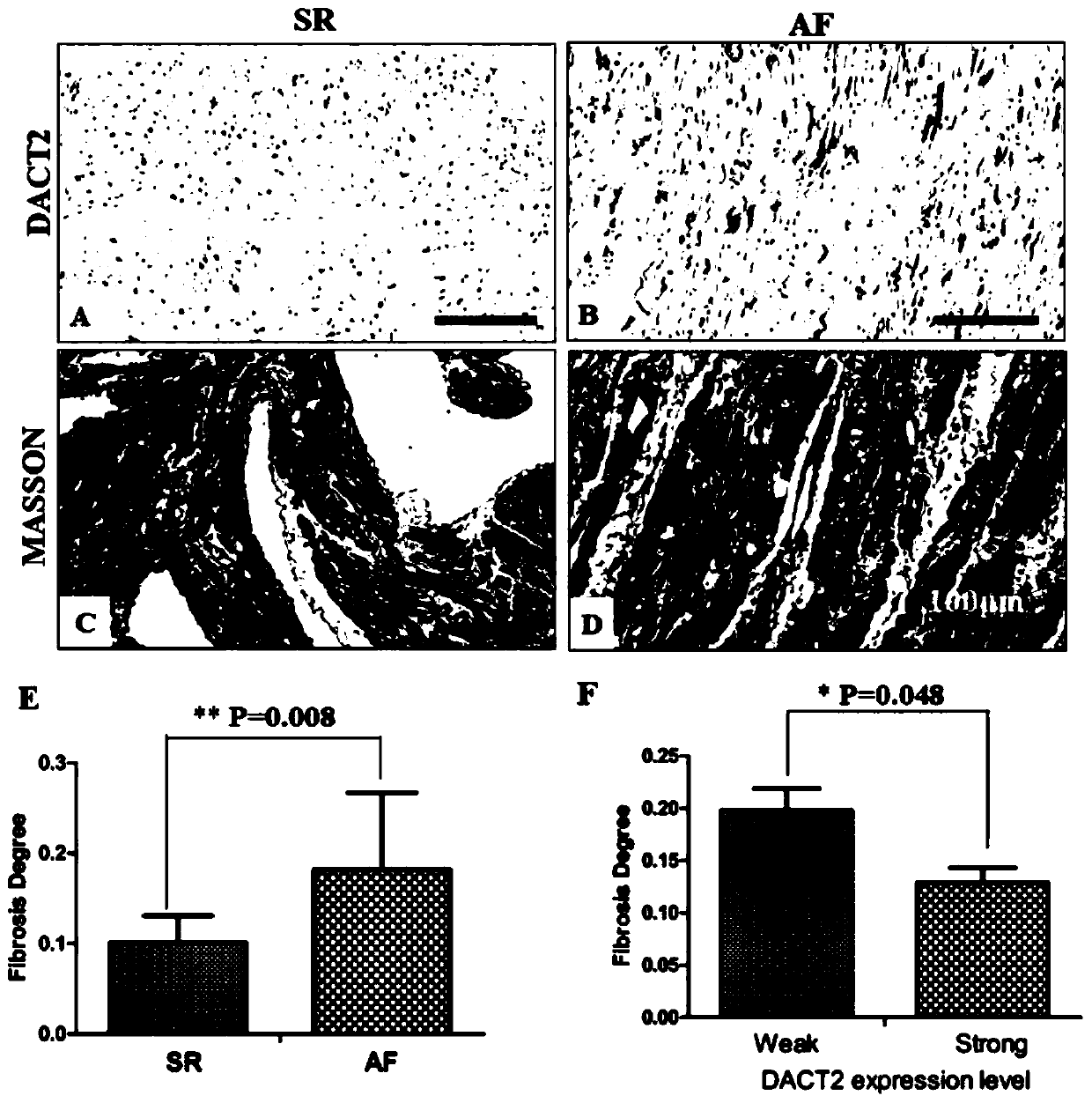 Application of DACT2 gene in preparation of product for diagnosis and treatment of atrial fibrillation