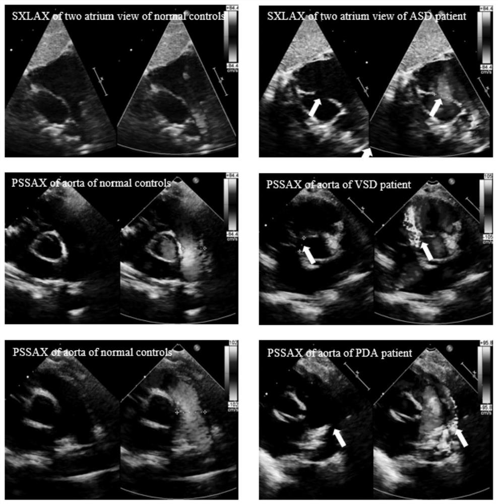 Children congenital heart disease intelligent diagnosis system based on echocardiography