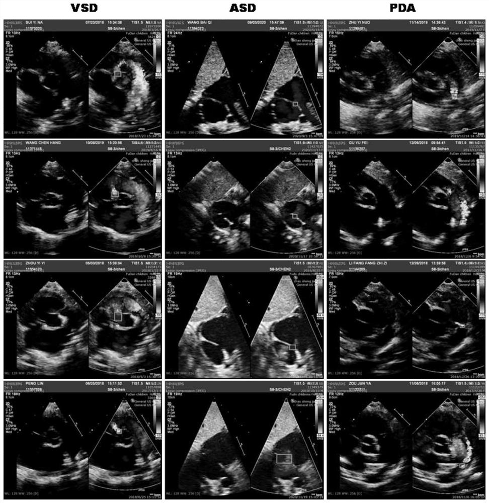 Children congenital heart disease intelligent diagnosis system based on echocardiography
