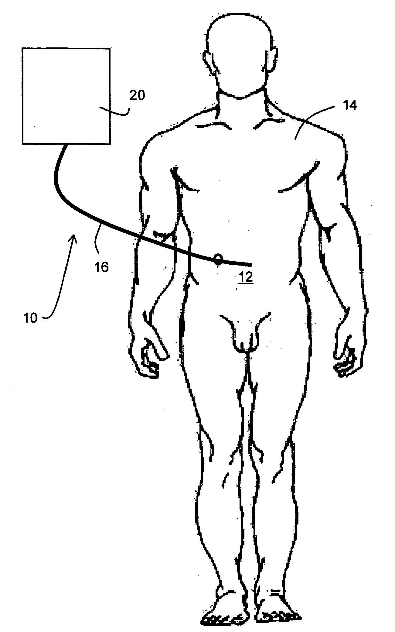 Hypothermia Devices and Methods