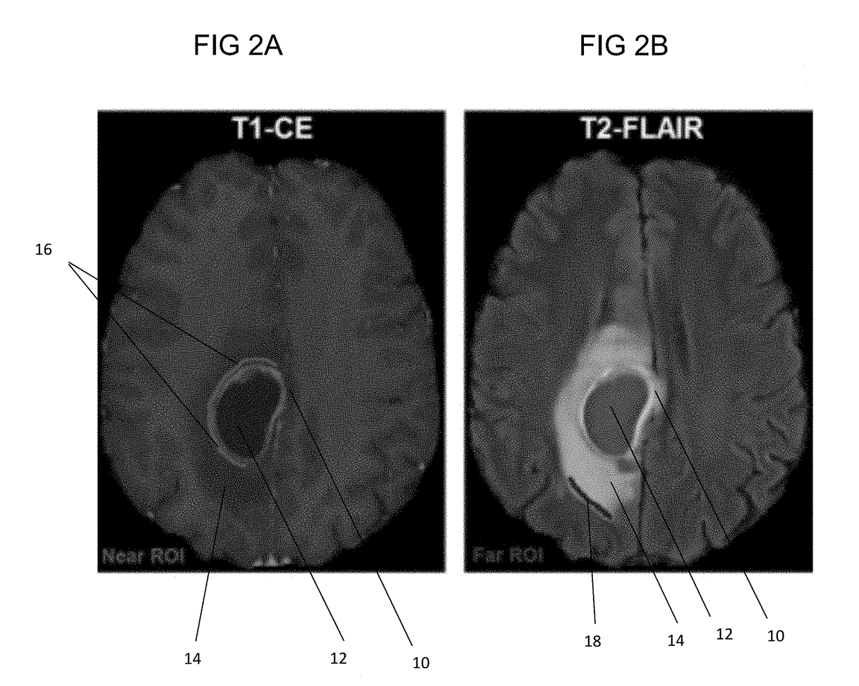 Vivo detection of EGFR mutation in glioblastoma via MRI signature consistent with deep peritumoral infiltration