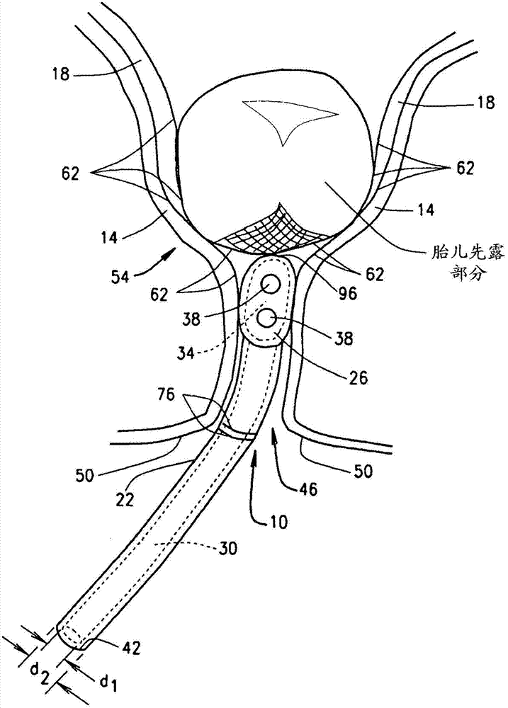 Device to assist delivery of fetal head at cesarean section