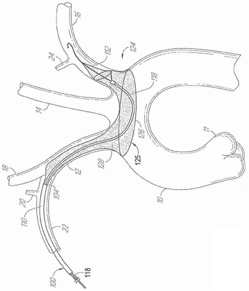 Systems for protecting the cerebral vasculature