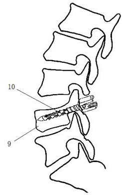 Percutaneous support-dilated bone-scraped vertebral body shaping device
