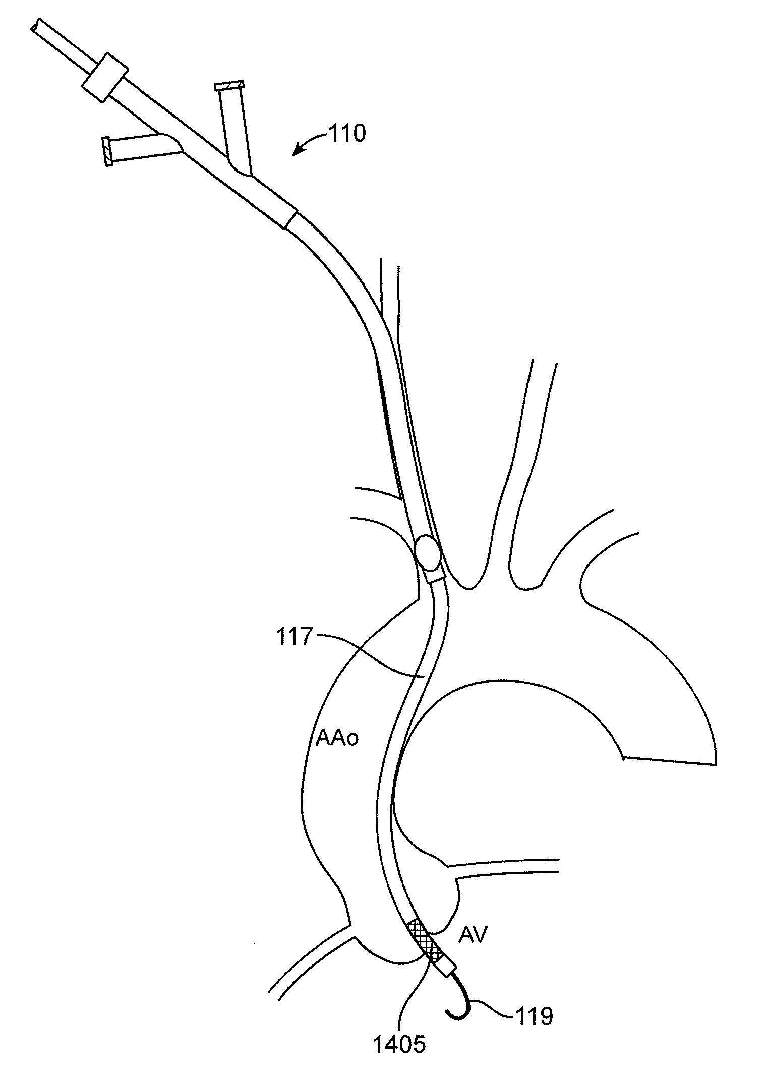 Systems and methods for transcatheter aortic valve treatment