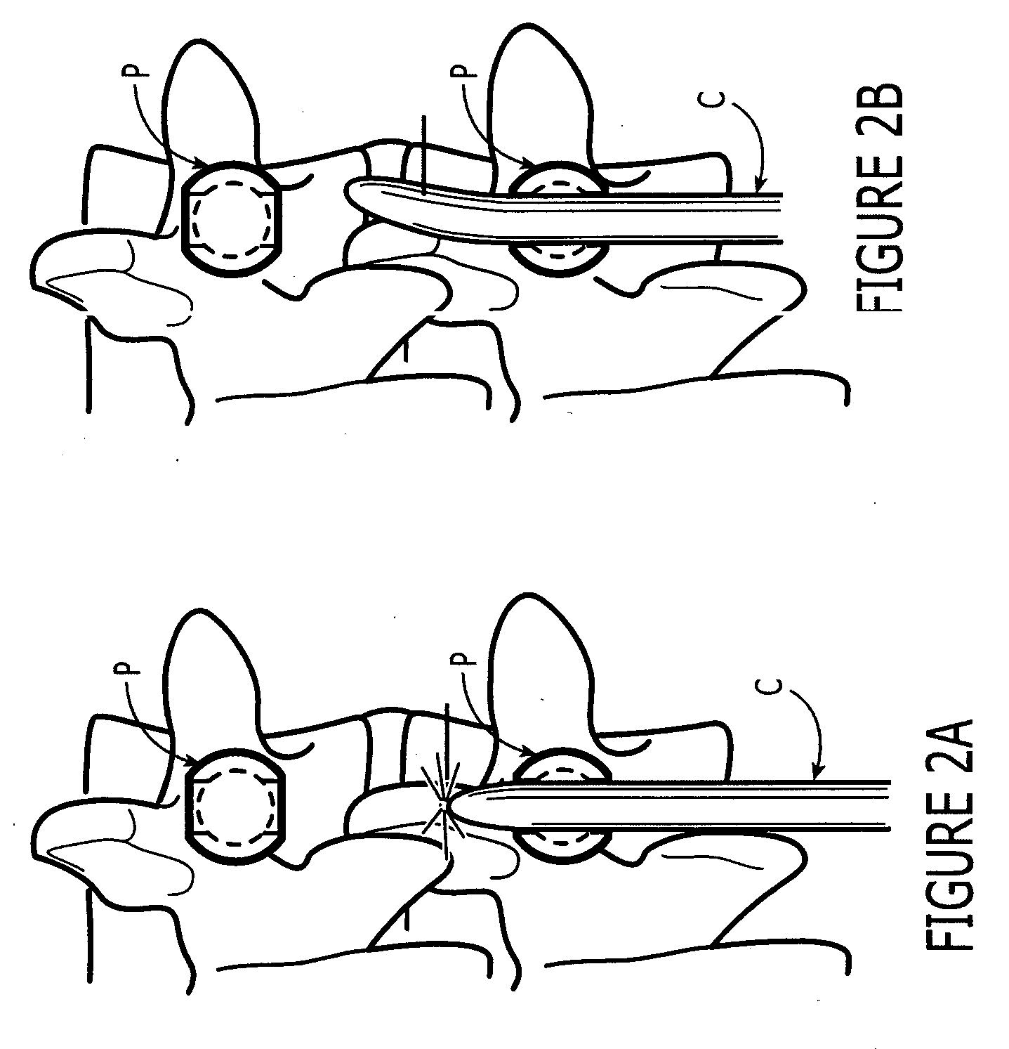 Rod delivery device and method