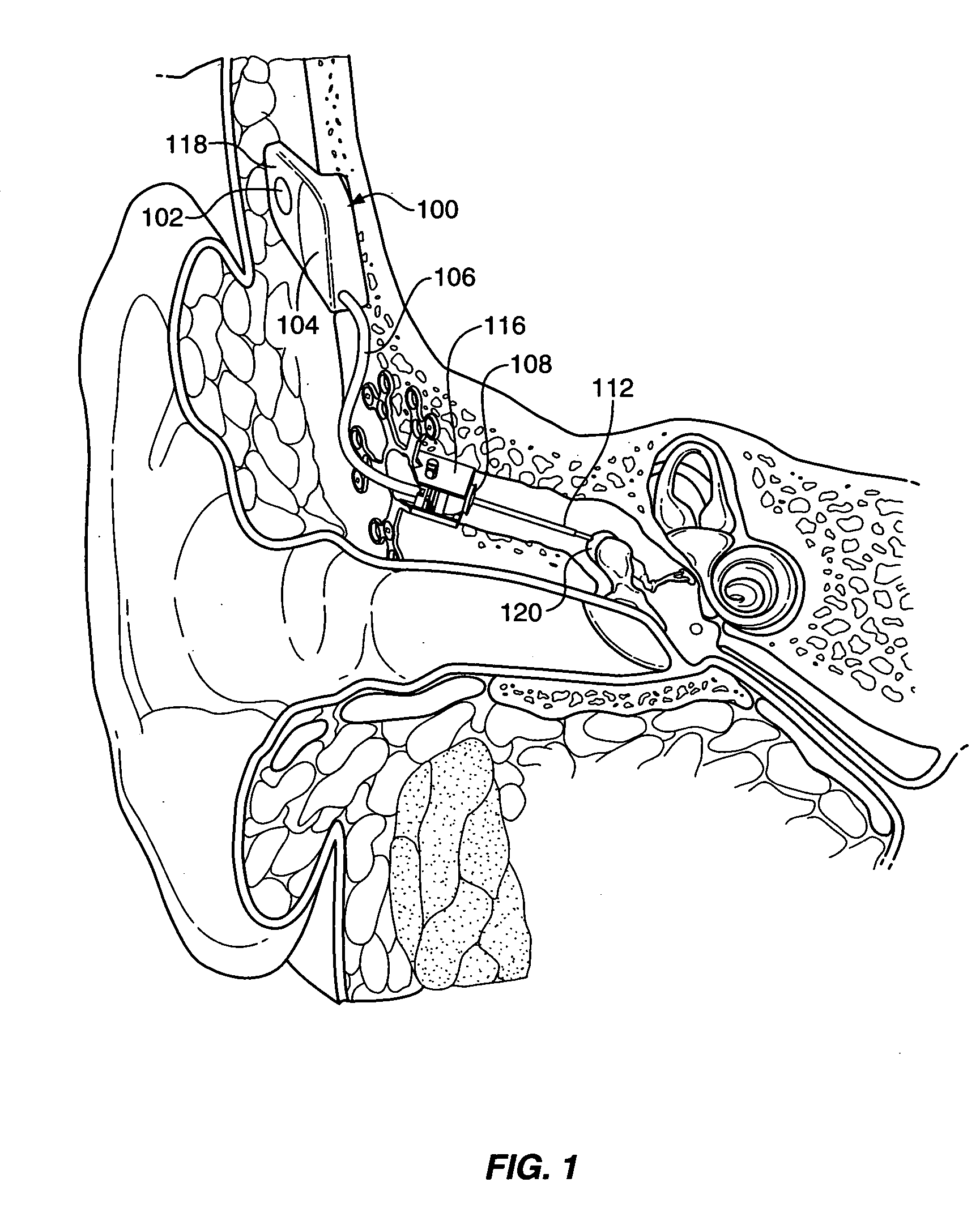 Implantable hearing aid transducer system