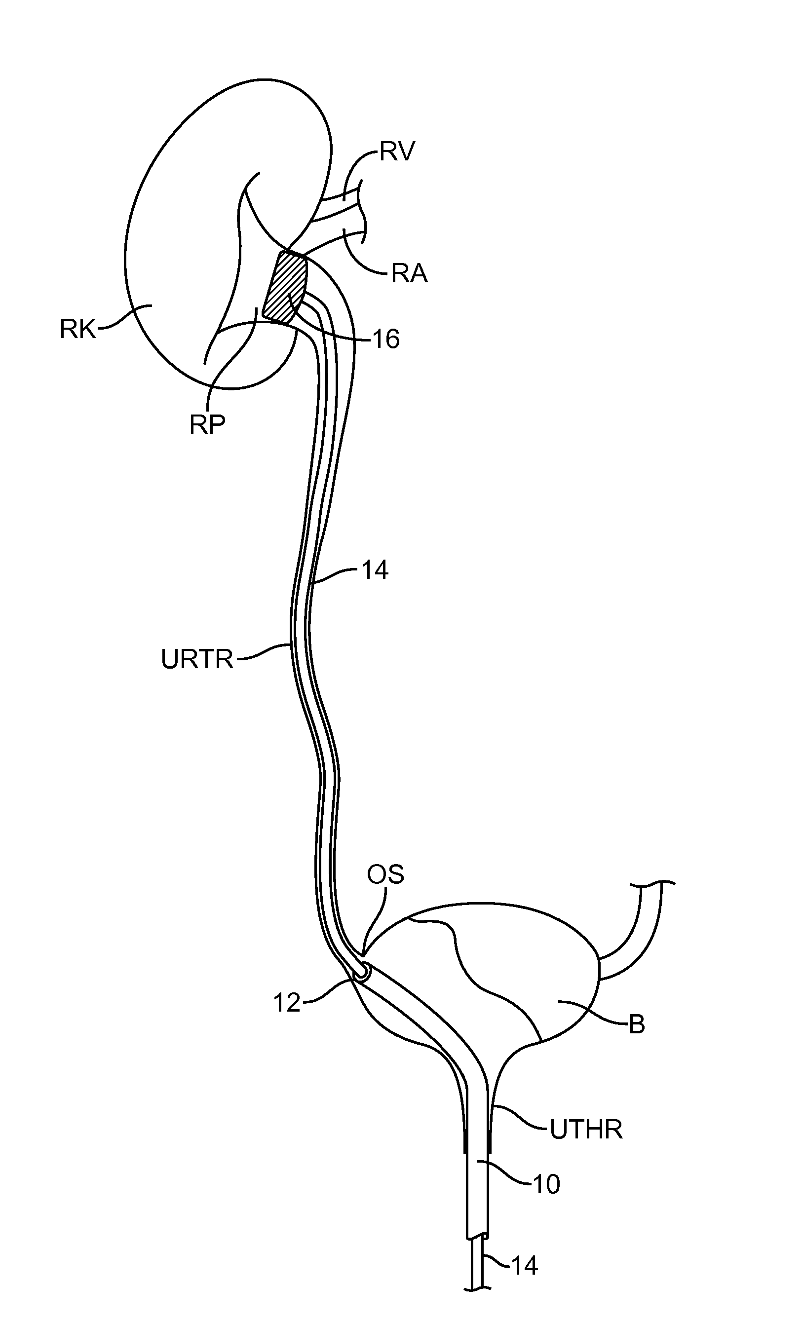 Renal nerve denervation via the renal pelvis