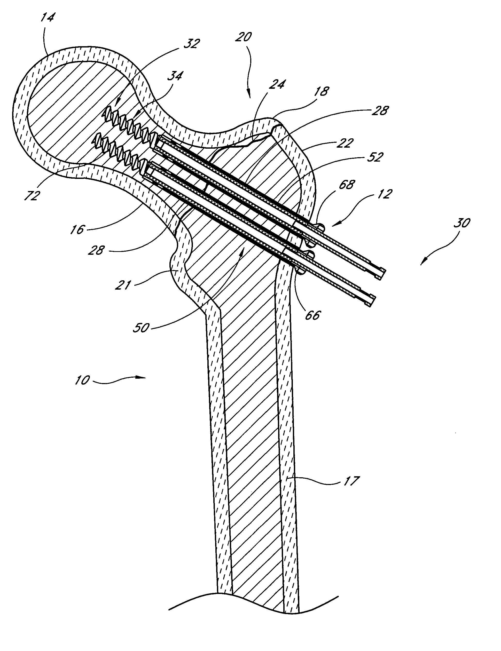 Method and apparatus for delivering an agent