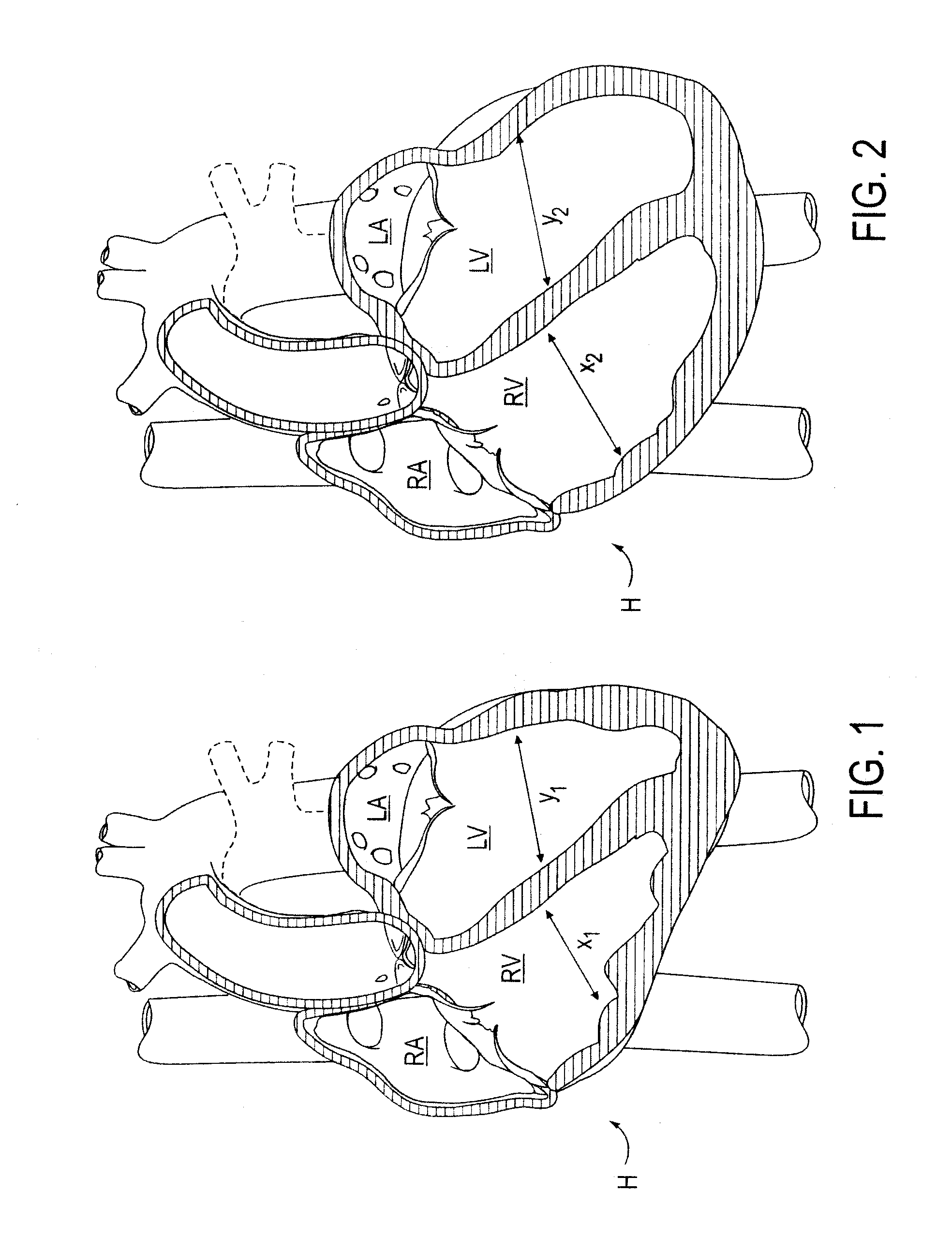 Methods and systems for cardiac remodeling via resynchronization