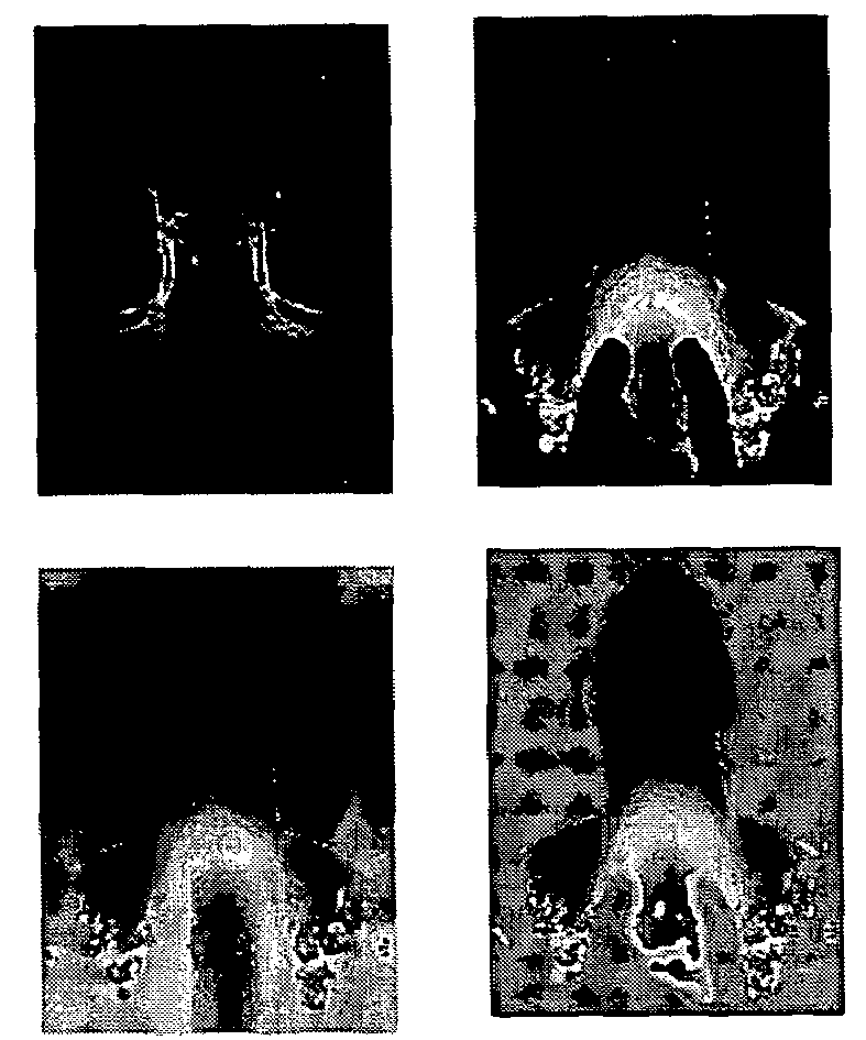Method for applying an in-painting technique to correct images in parallel imaging