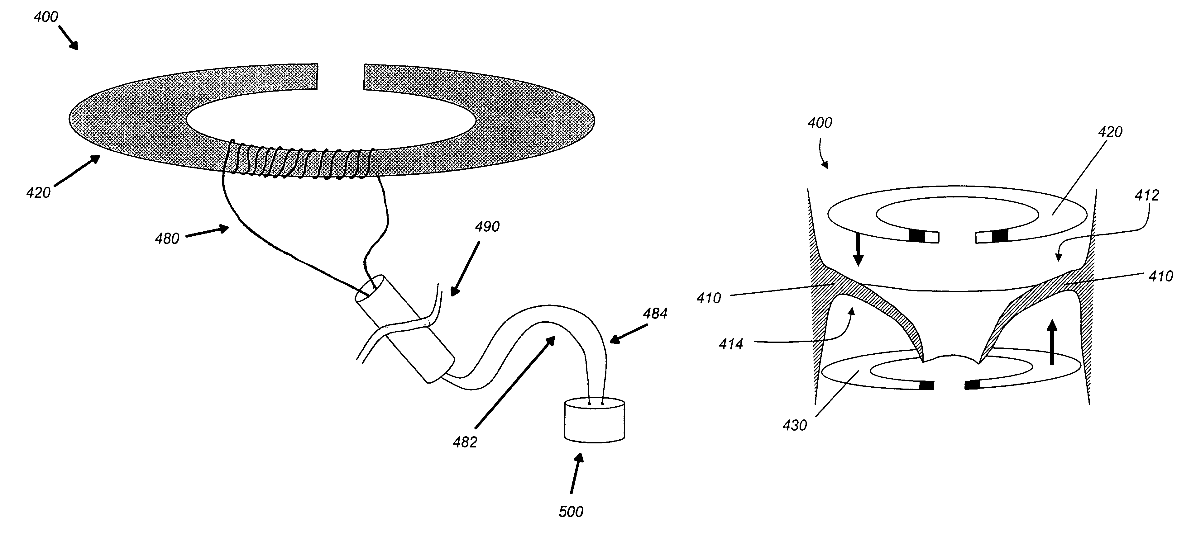 Systems and methods for valve annulus remodeling