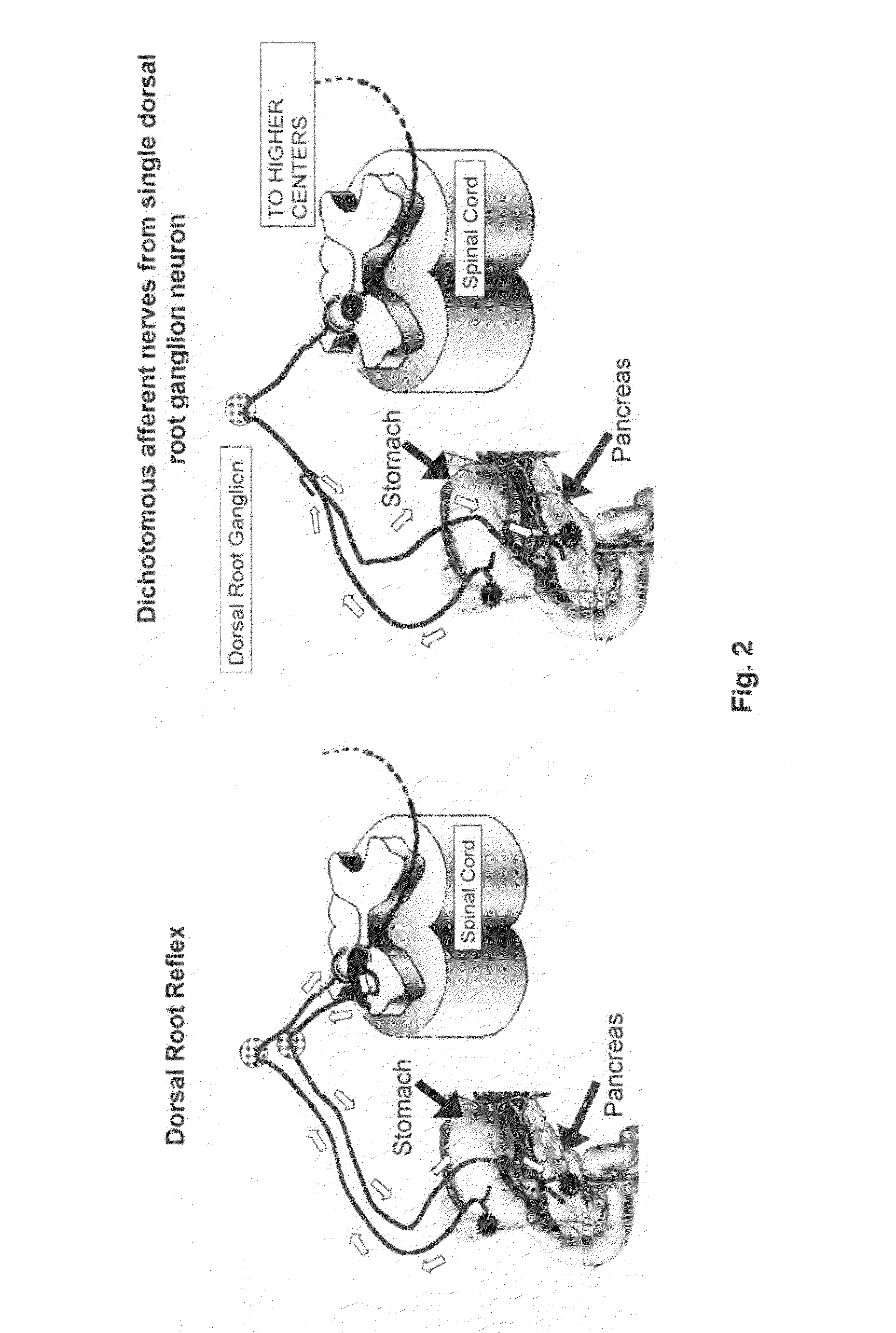 Modulation of nerve pain activity by resiniferatoxin and uses thereof