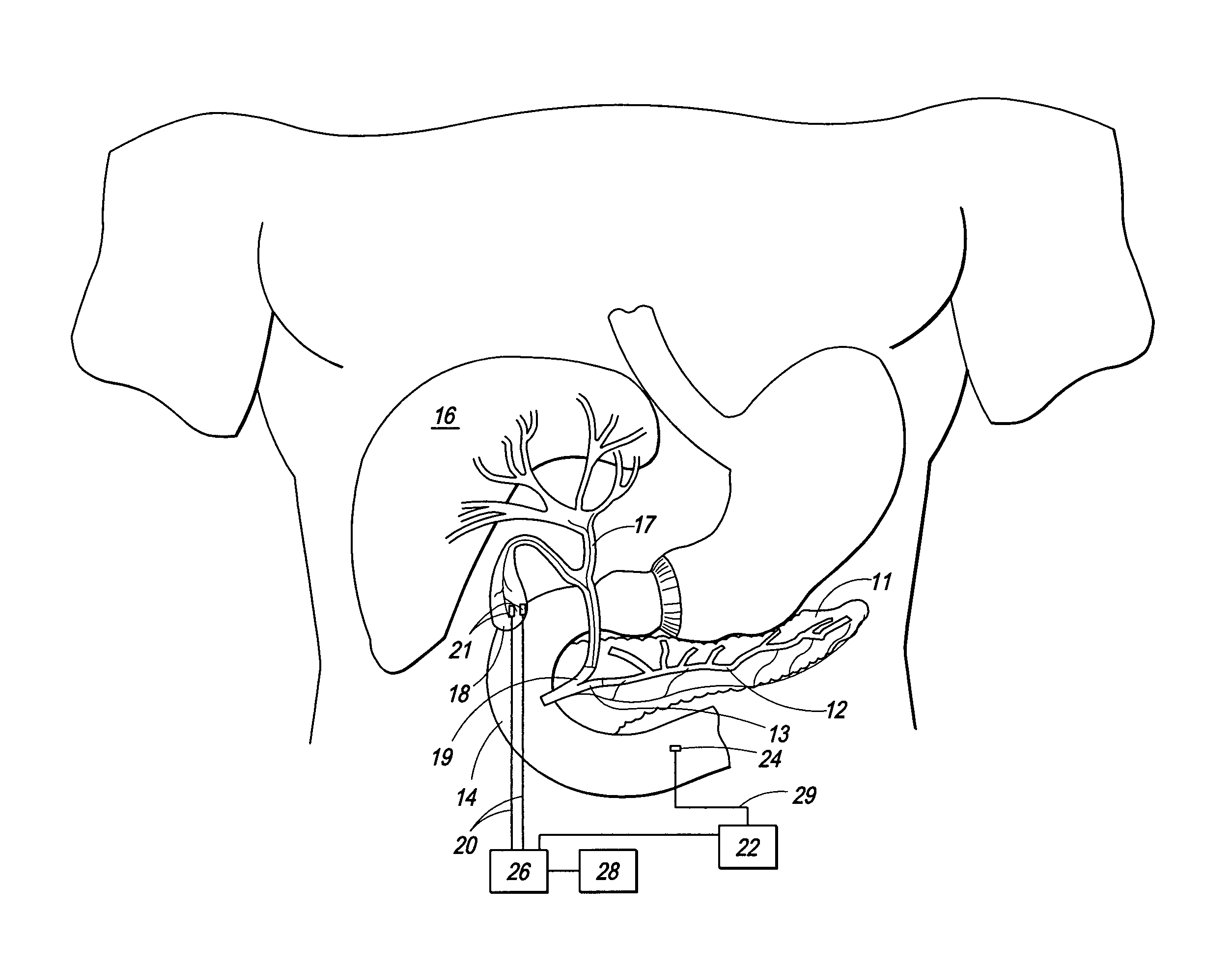 Method and apparatus for electrical stimulation of the pancreatico-biliary system