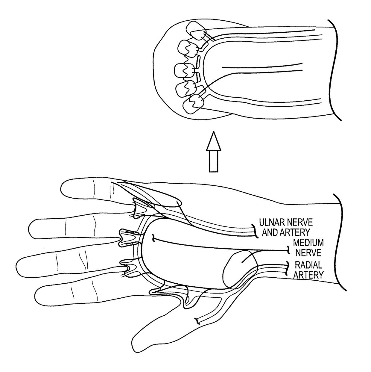Myoelectric prosthesis and method