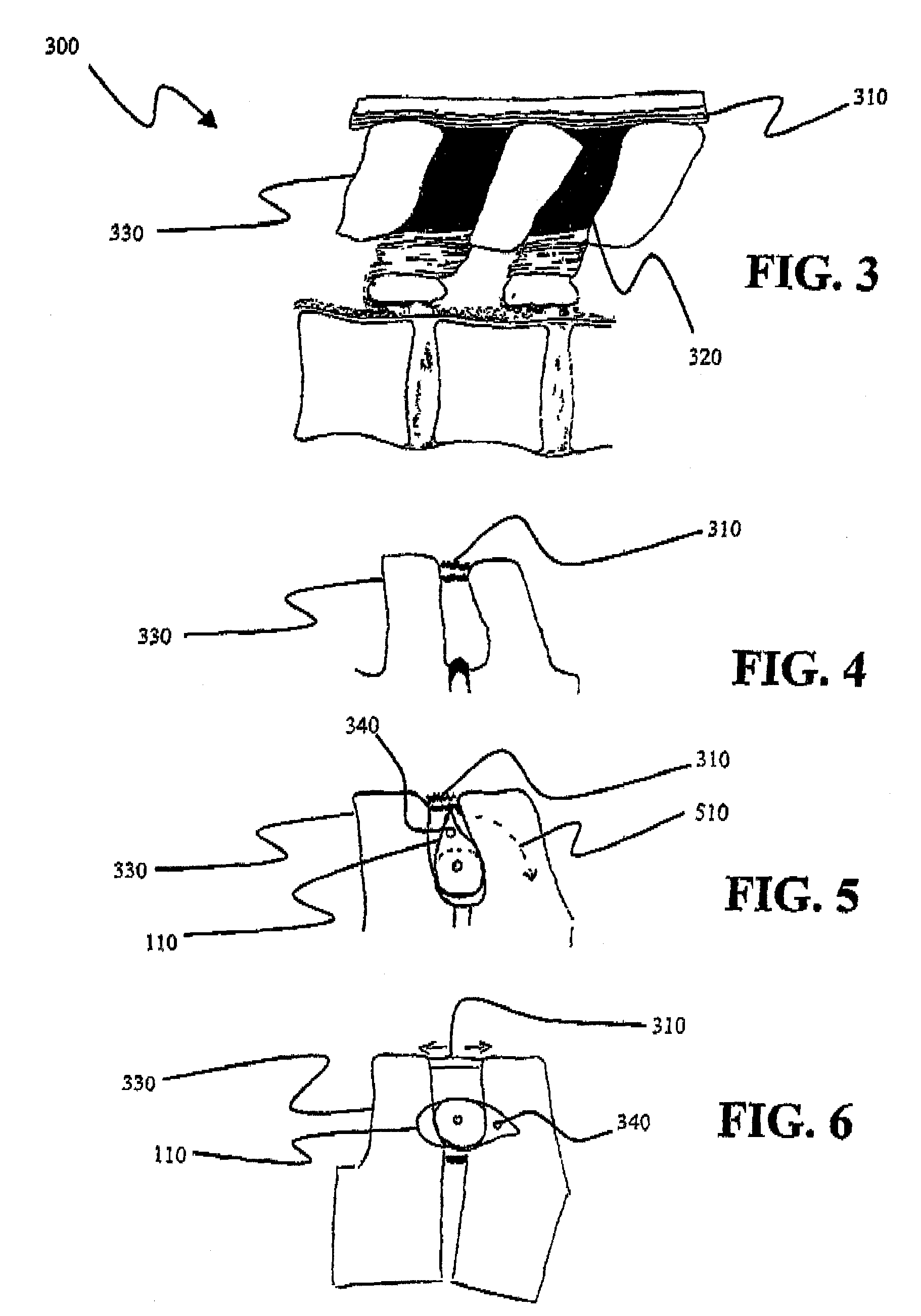 Interspinous internal fixation/distraction device