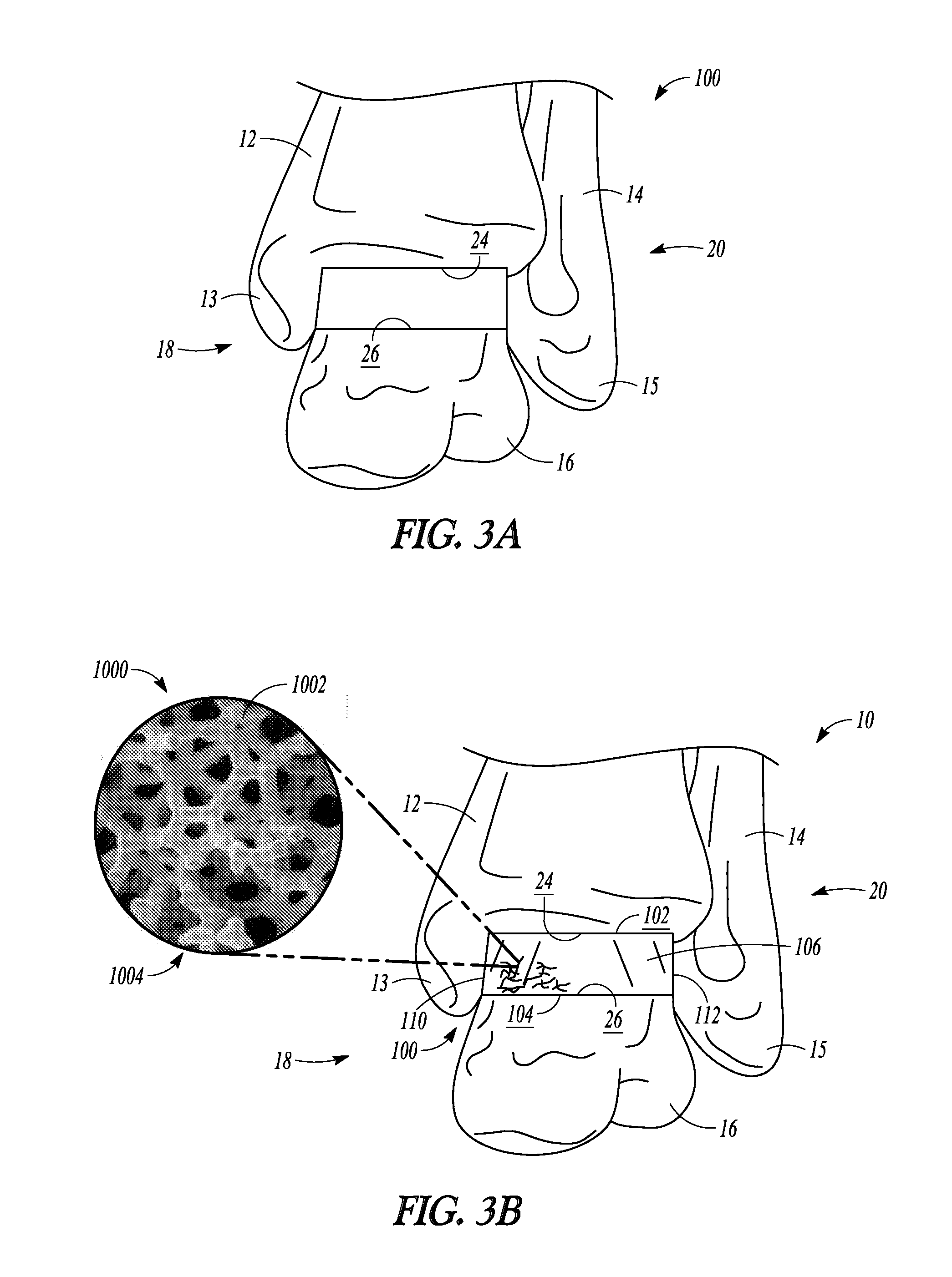 Porous spacers, instruments, and methods for foot and ankle fusion