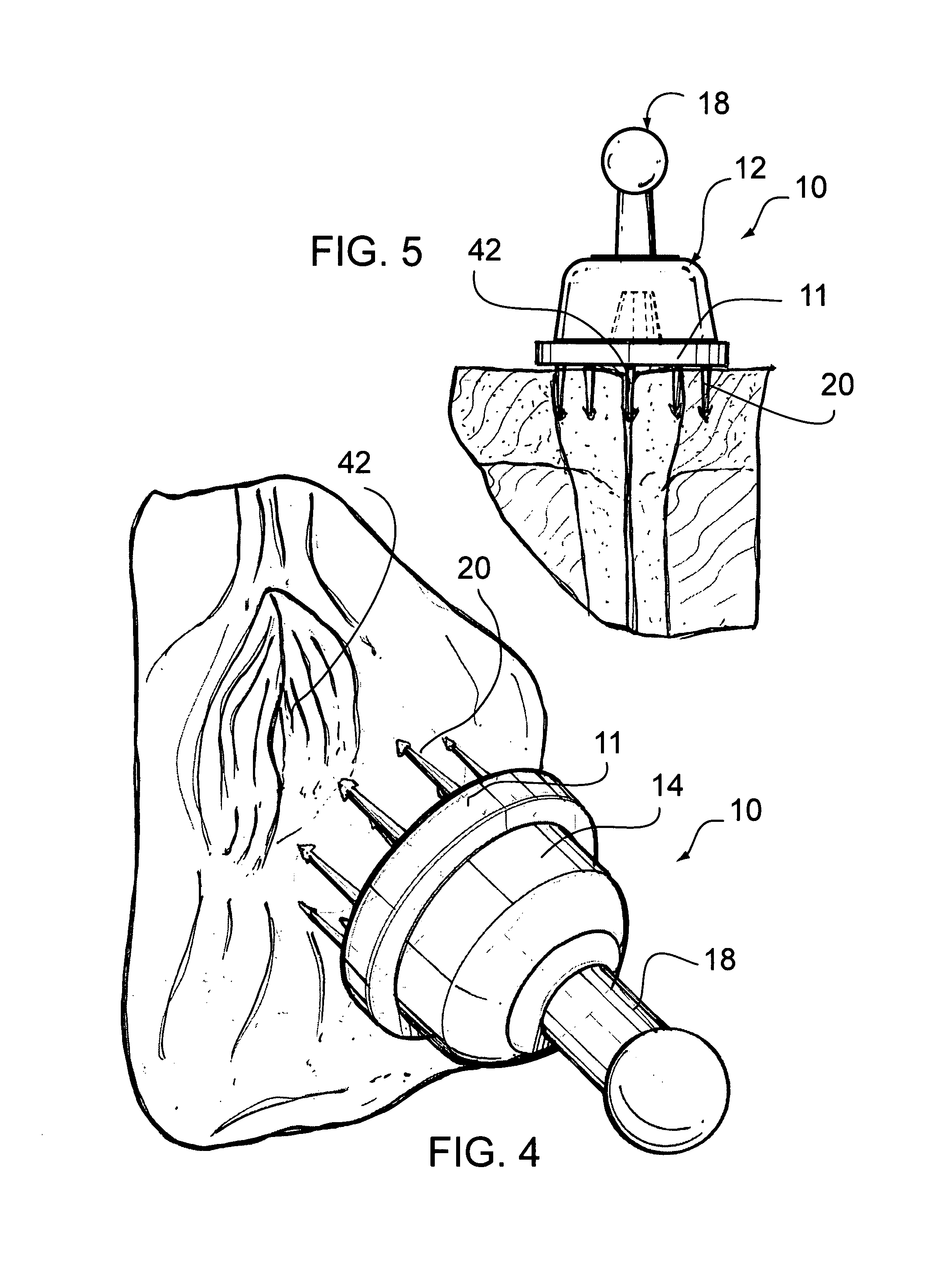 Apparatus and method for preventing fluid transfer between an oviduct and a uterine cavity