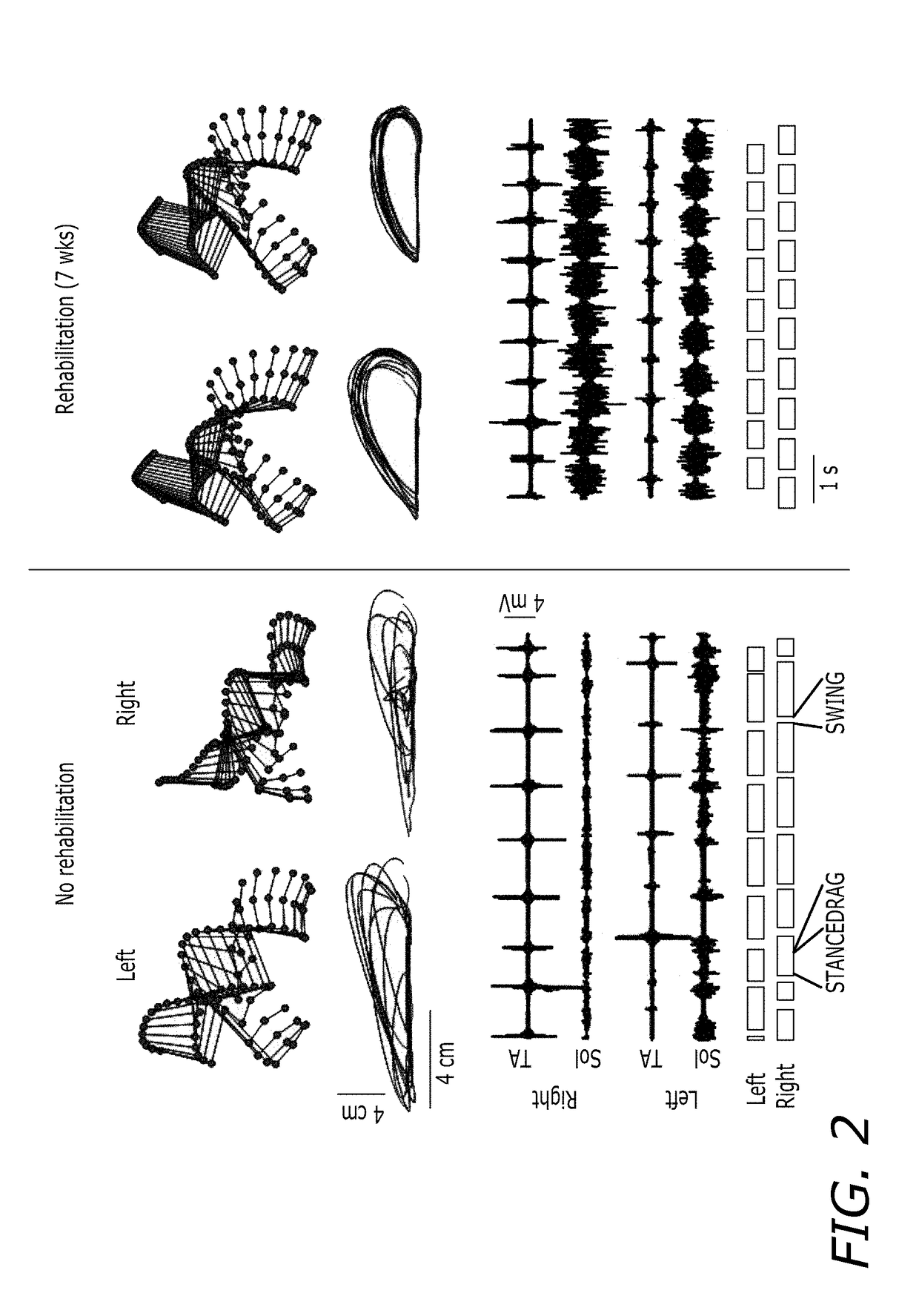Epidural stimulation for facilitation of locomotion, posture, voluntary movement, and recovery of autonomic, sexual, vasomotor, and cognitive function after neurological injury
