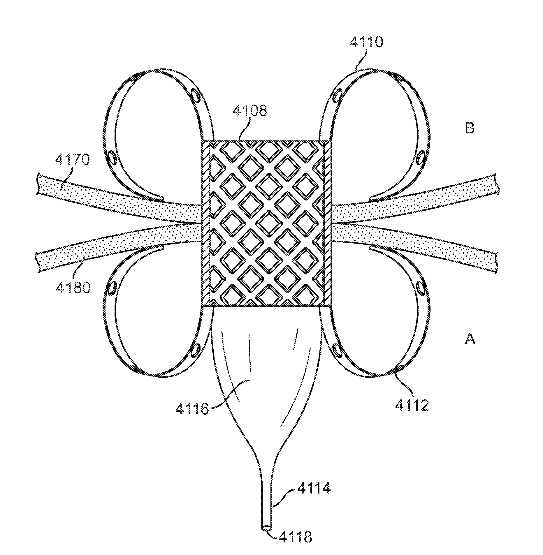 Luminal Structure Anchoring Devices and Methods