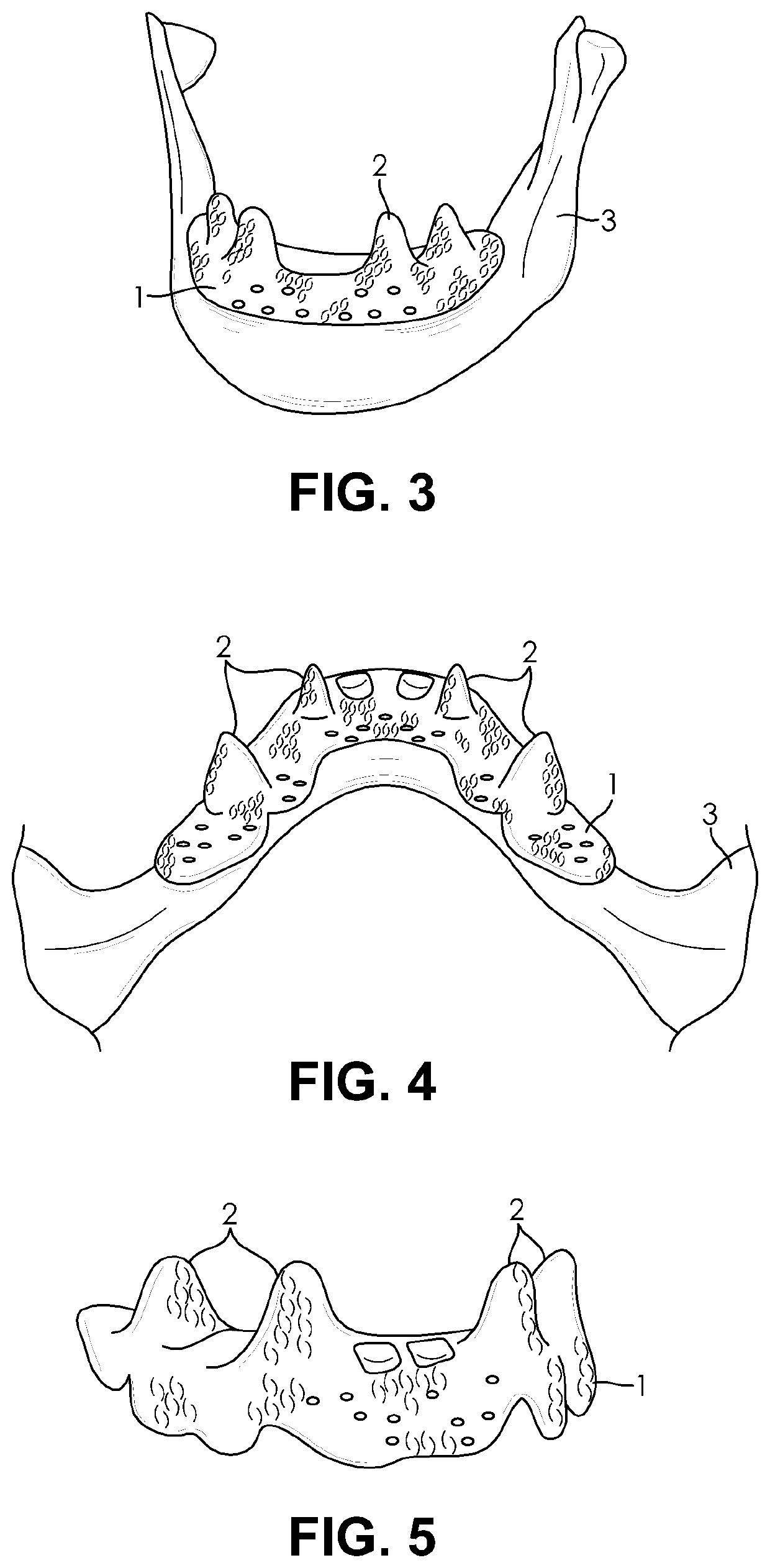 Customized porous supracrestal implant and materials and methods forming them