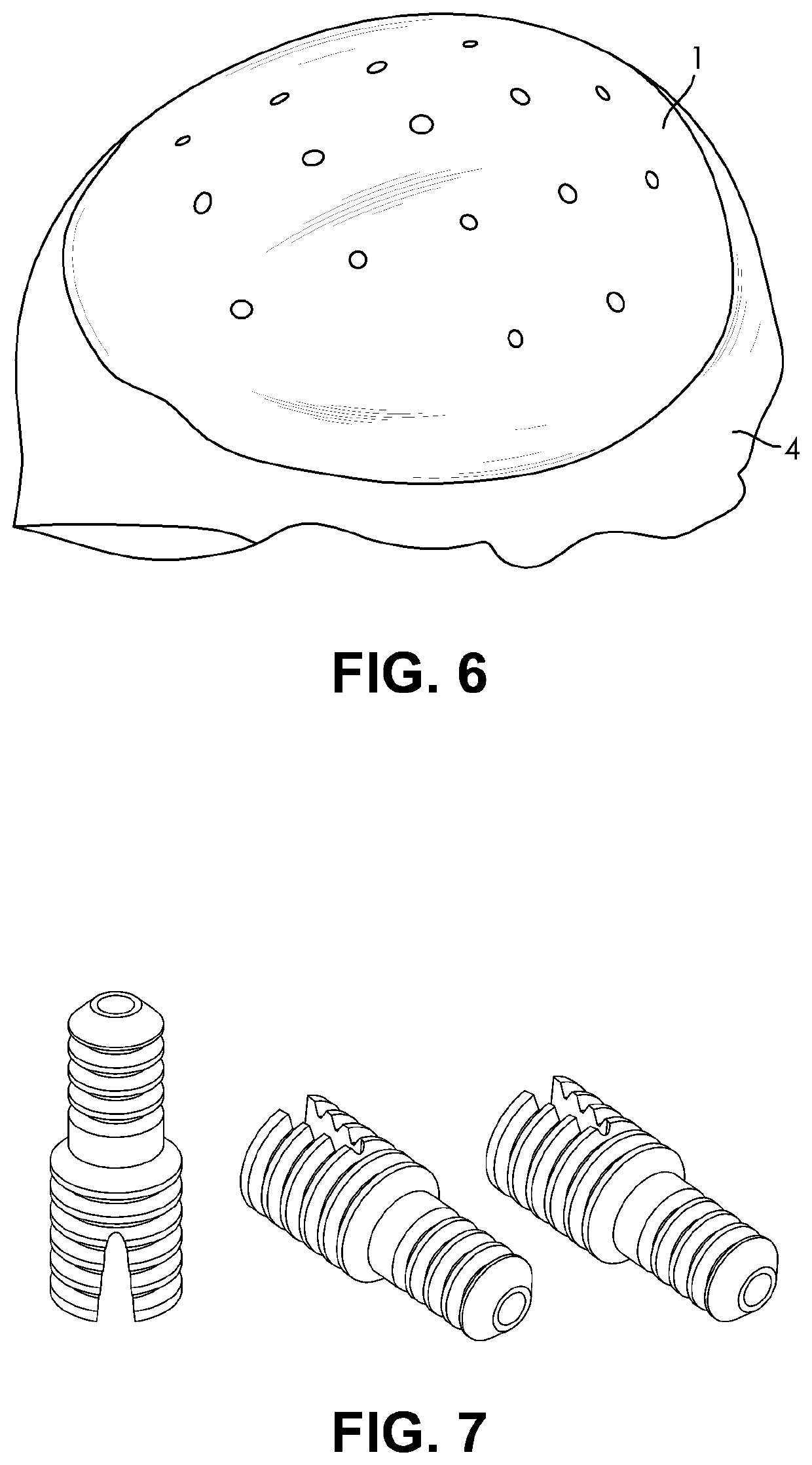 Customized porous supracrestal implant and materials and methods forming them