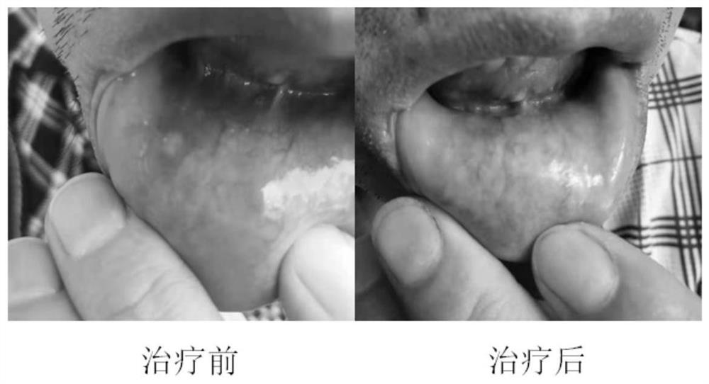 A traditional Chinese medicine external use medicine for treating recurrent oral ulcer