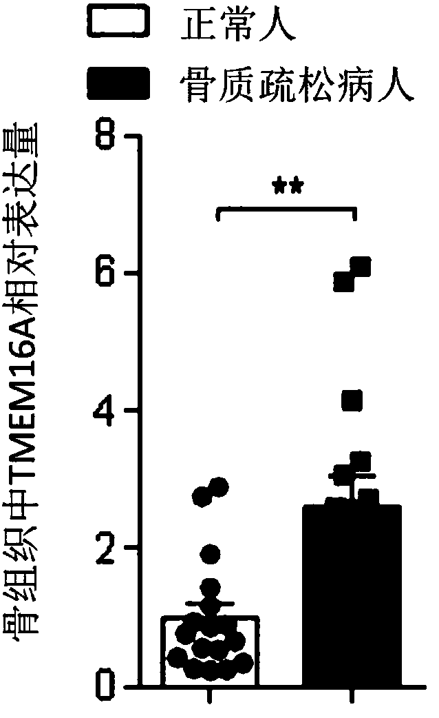 TMEM16A taken as osteoporosis marker as well as application, osteoporosis diagnostic kit and medicine thereof