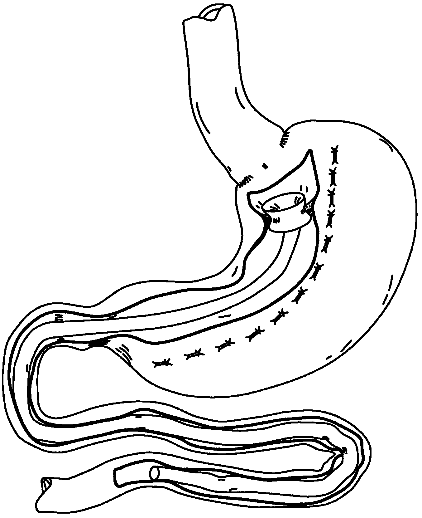 Endolumenal esophageal restriction device