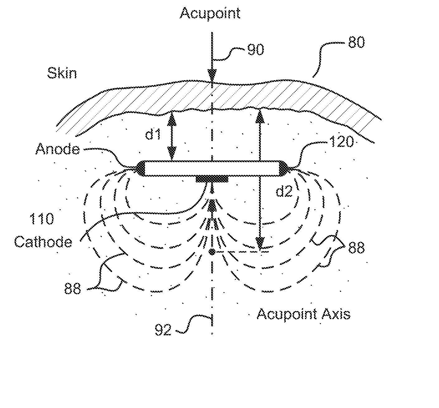 Methods and Systems for Treating Hypertension Using An Implantable Electroacupuncture Device