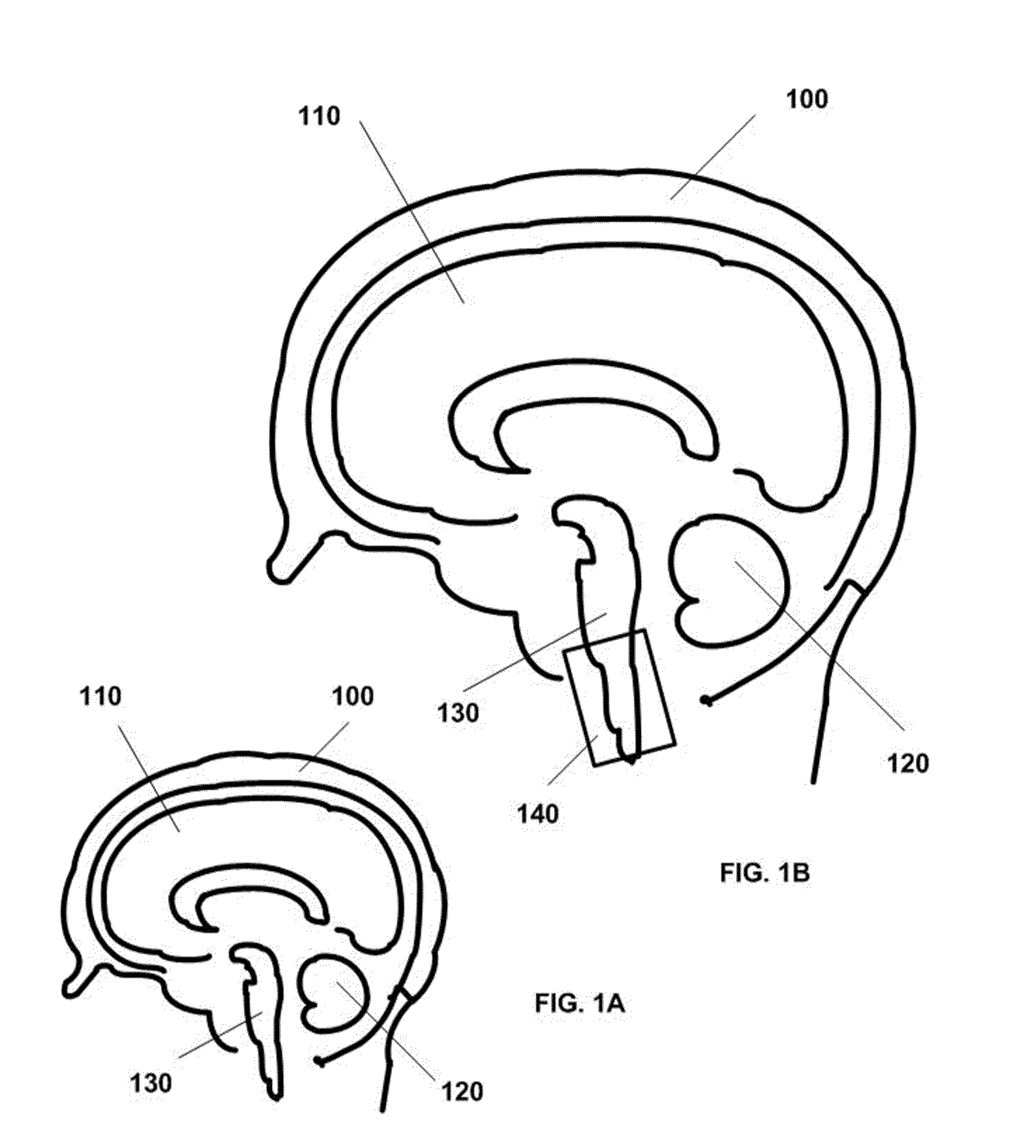 Ultrasound neuromodulation of the reticular activating system