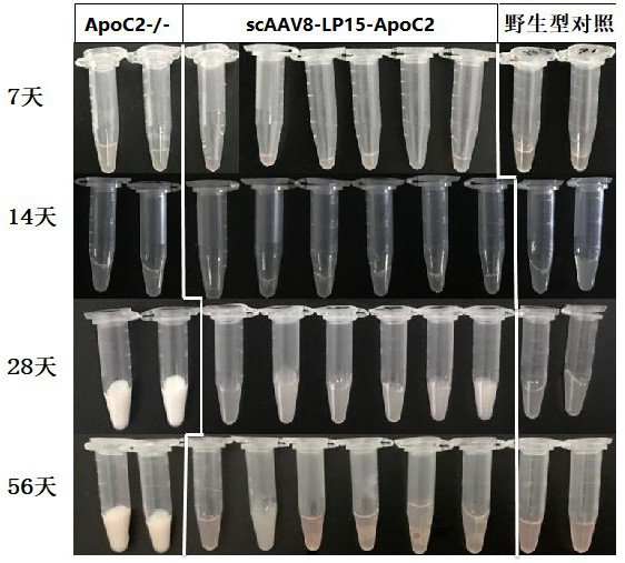 A gene medicine for the treatment of severe hypertriglyceridemia