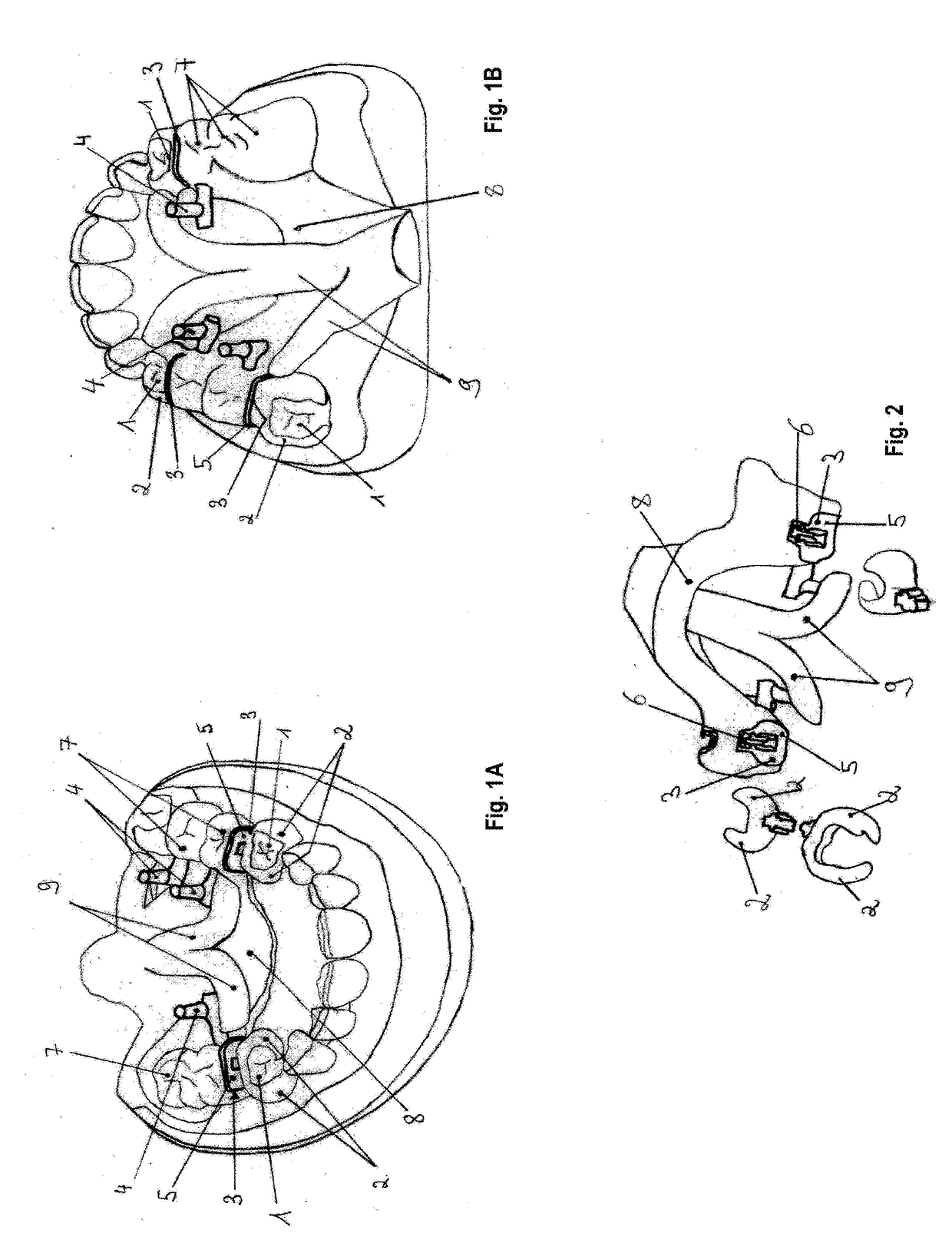 Method of making a dental prosthesis