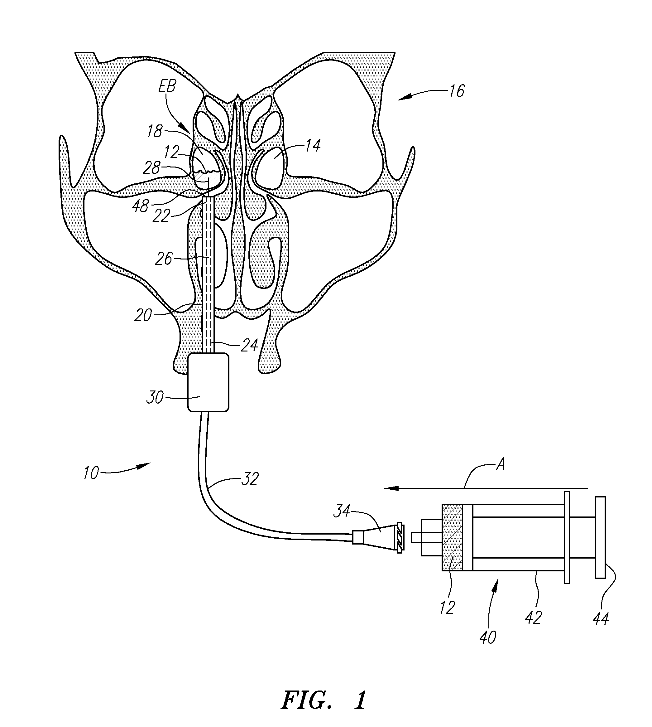 Apparatus and method for treatment of ethmoids