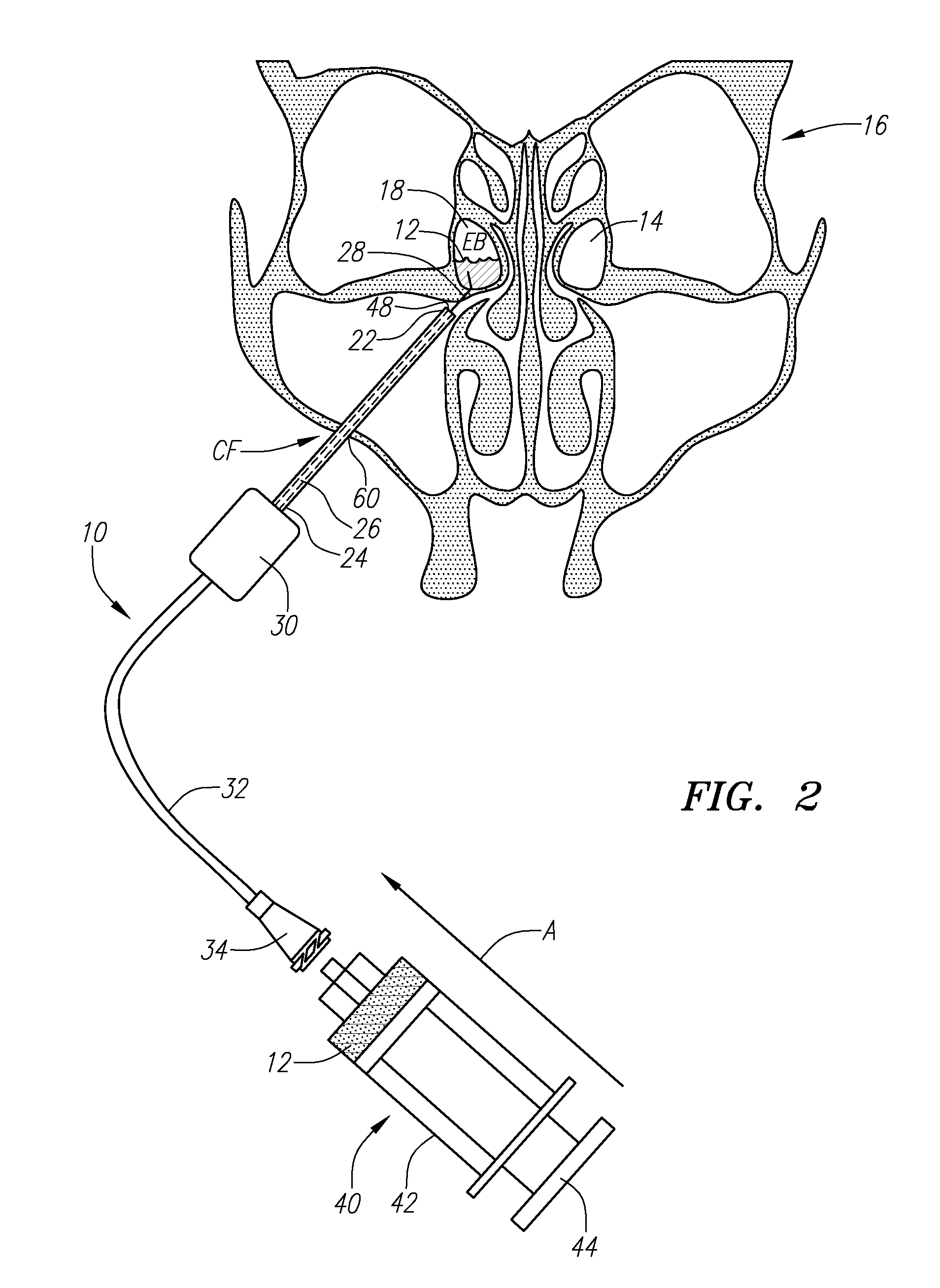 Apparatus and method for treatment of ethmoids