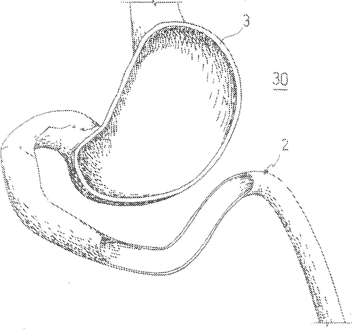 A carrier member, anastomotic device and instrumentation for performing endoluminal and/or transluminal anastomosis