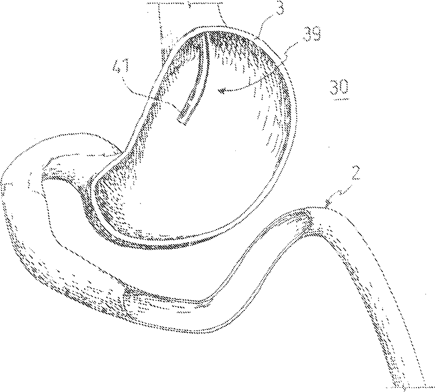 A carrier member, anastomotic device and instrumentation for performing endoluminal and/or transluminal anastomosis