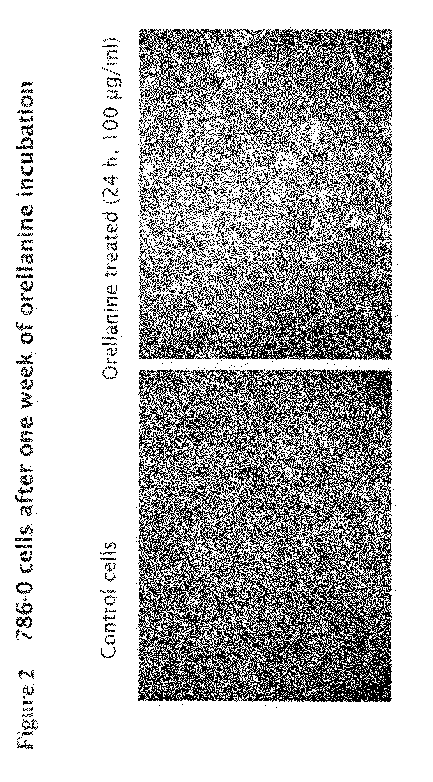 Treatment of renal cell carcinoma