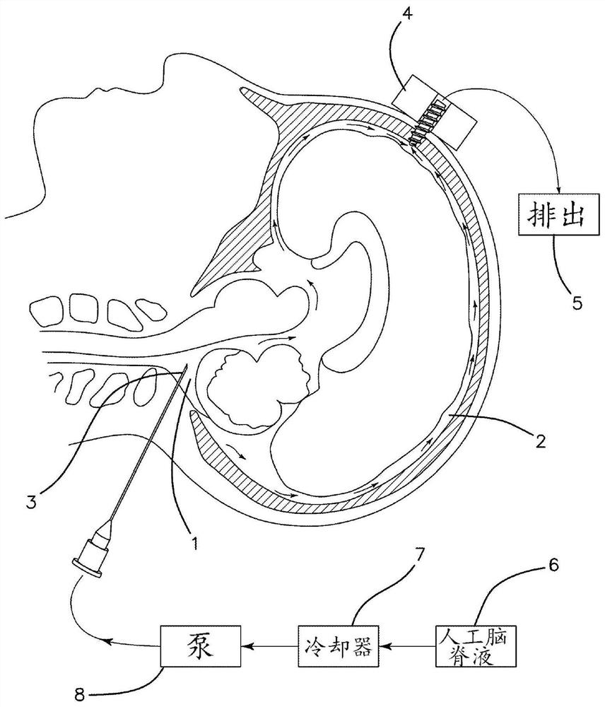 Device and method for cooling brain and diagnosing and treating glioblastoma